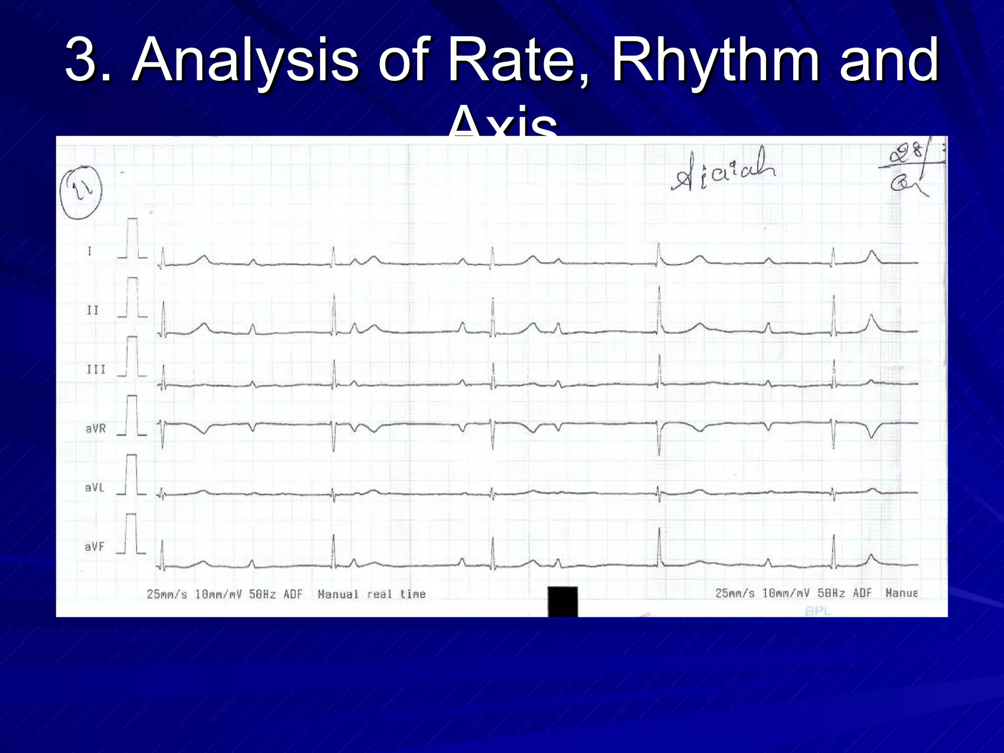 3. Analysis of Rate, Rhythm and Axis 