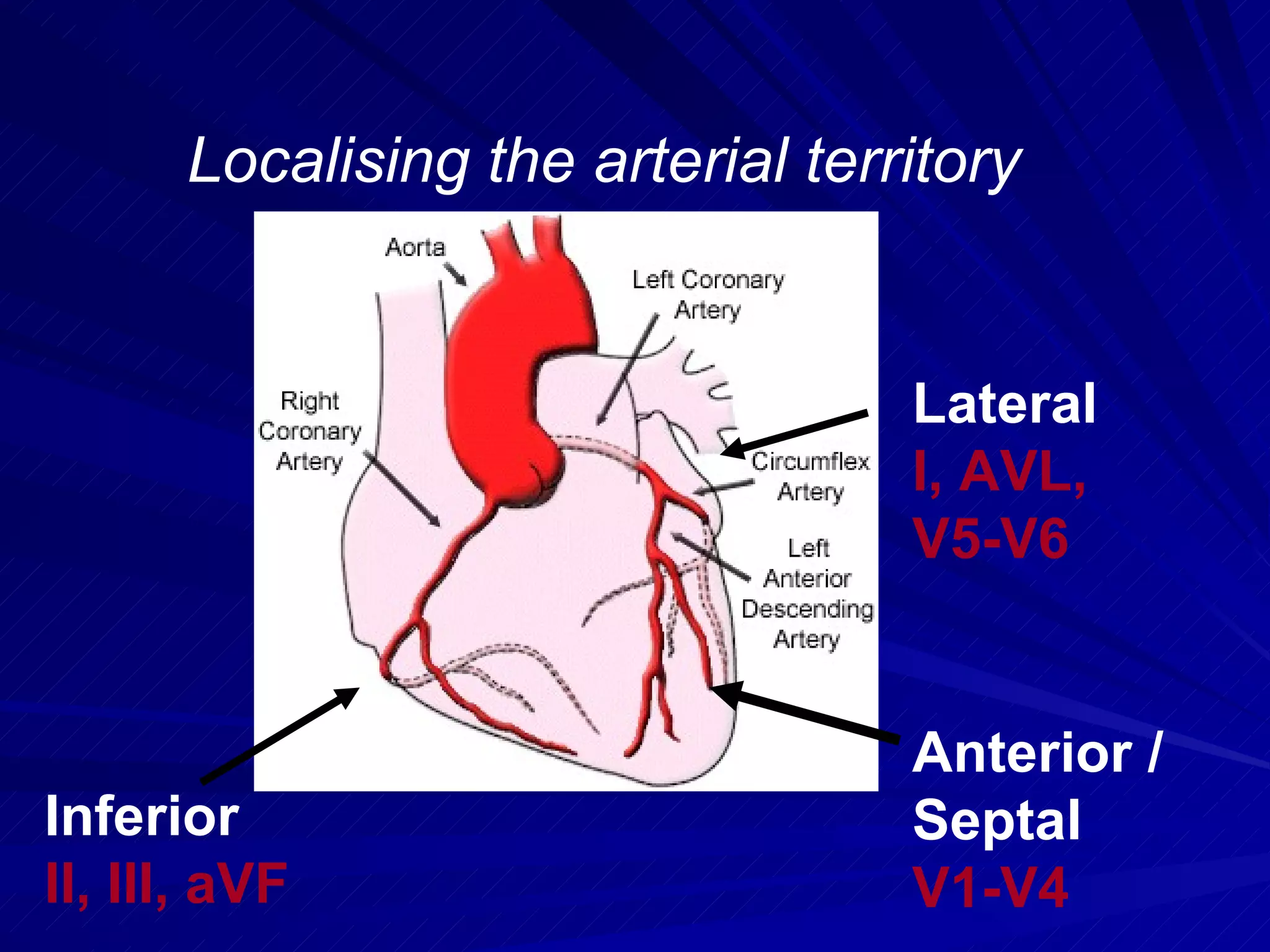 Localising the arterial territory Inferior II, III, aVF Lateral I, AVL,  V5-V6 Anterior /  Septal V1-V4 