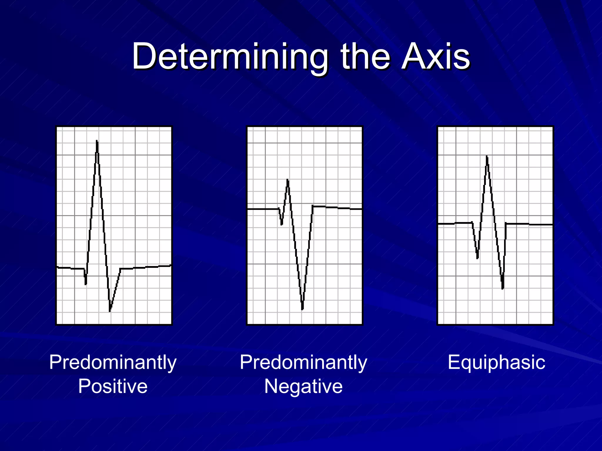 Determining the Axis Predominantly Positive Predominantly Negative Equiphasic 