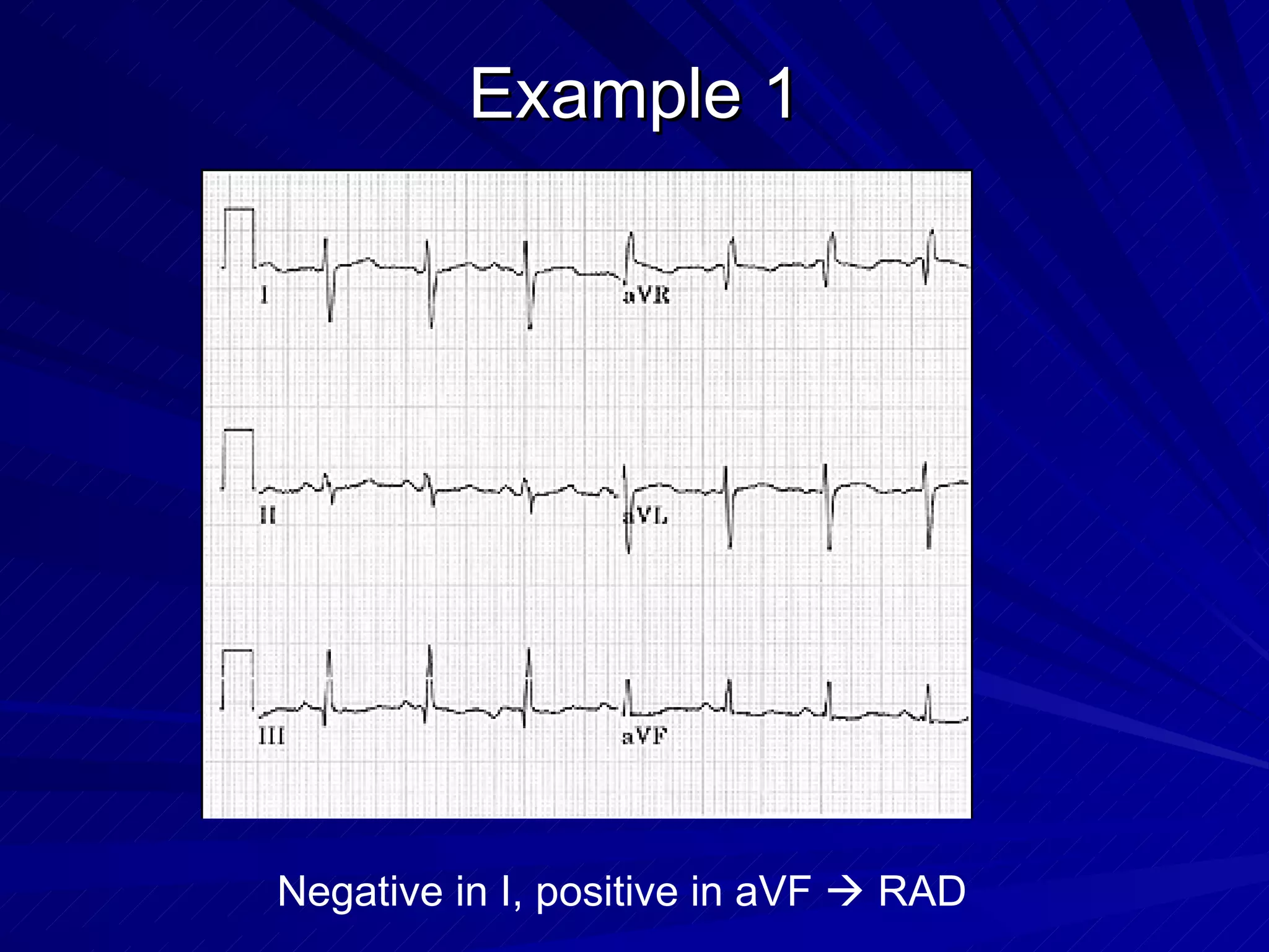 Example 1 Negative in I, positive in aVF    RAD 