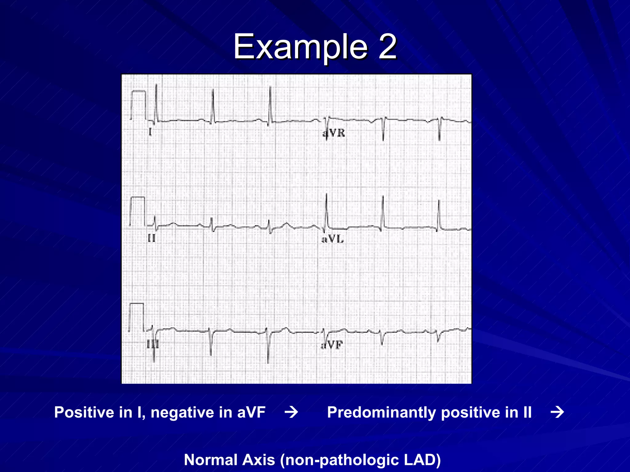 Example 2 Positive in I, negative in aVF     Predominantly positive in II     Normal Axis (non-pathologic LAD) 