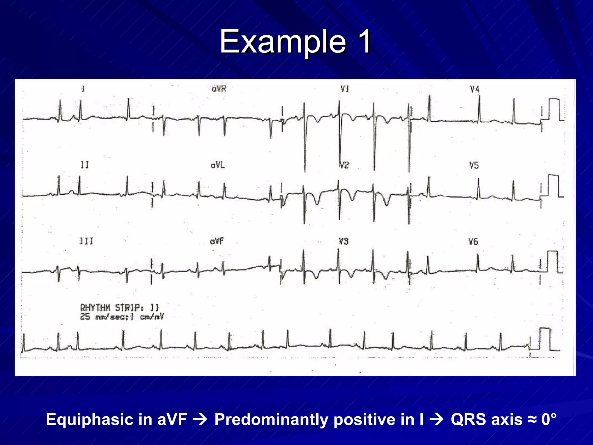 Example 1 Equiphasic in aVF    Predominantly positive in I    QRS axis  ≈ 0° 