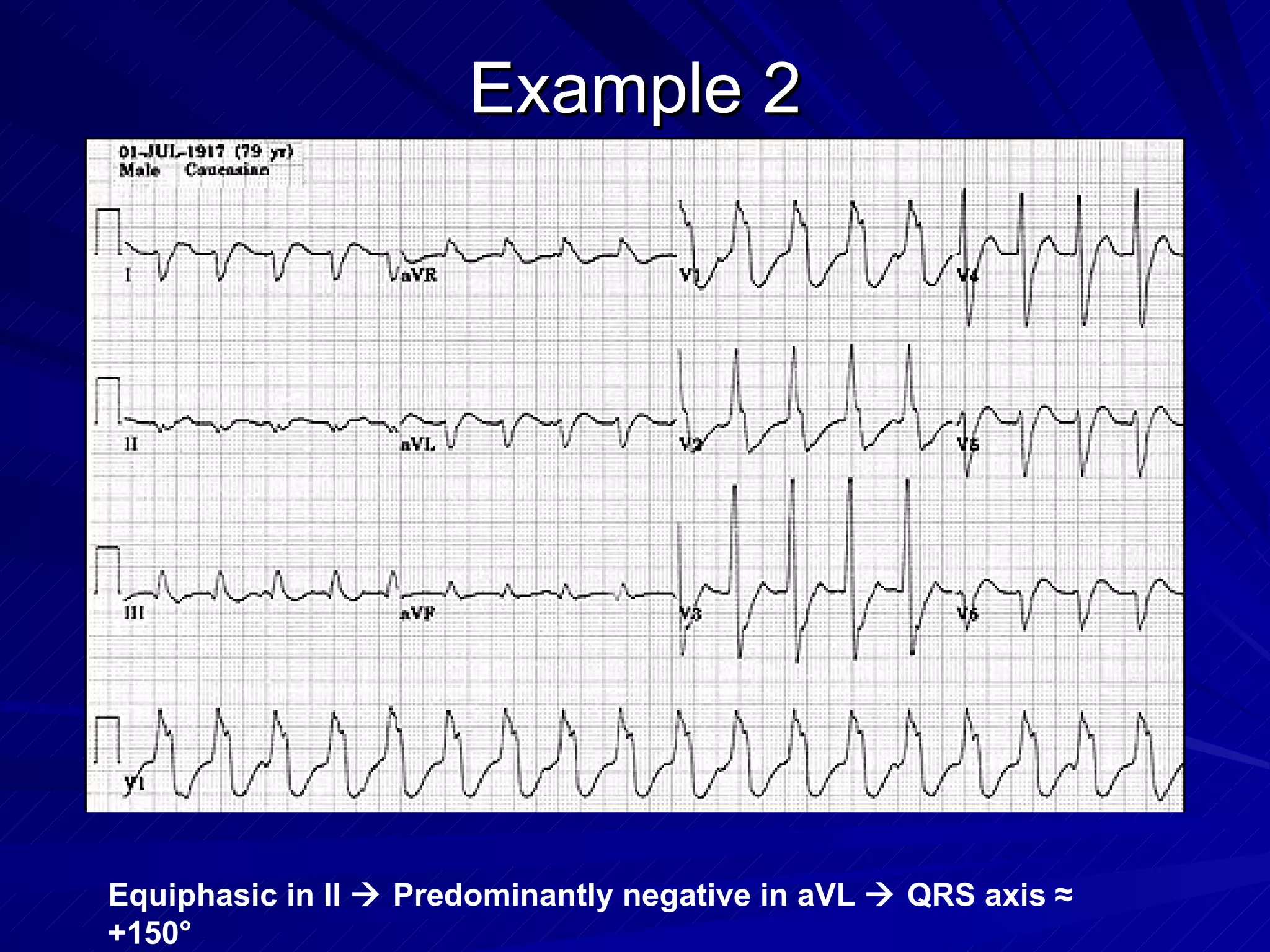Example 2 Equiphasic in II    Predominantly negative in aVL    QRS axis ≈ +150° 