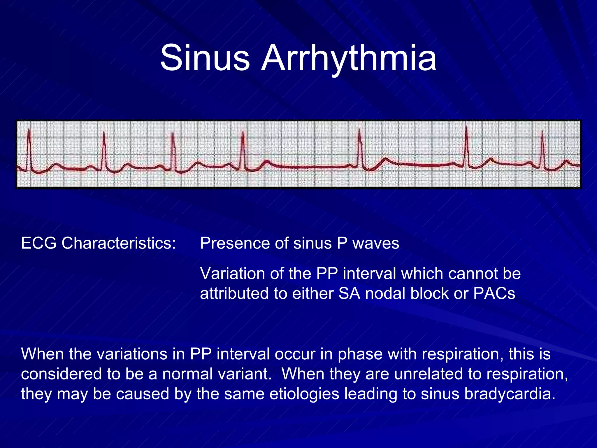 Sinus Arrhythmia ECG Characteristics: Presence of sinus P waves Variation of the PP interval which cannot be  attributed to either SA nodal block or PACs When the variations in PP interval occur in phase with respiration, this is considered to be a normal variant.  When they are unrelated to respiration, they may be caused by the same etiologies leading to sinus bradycardia. 