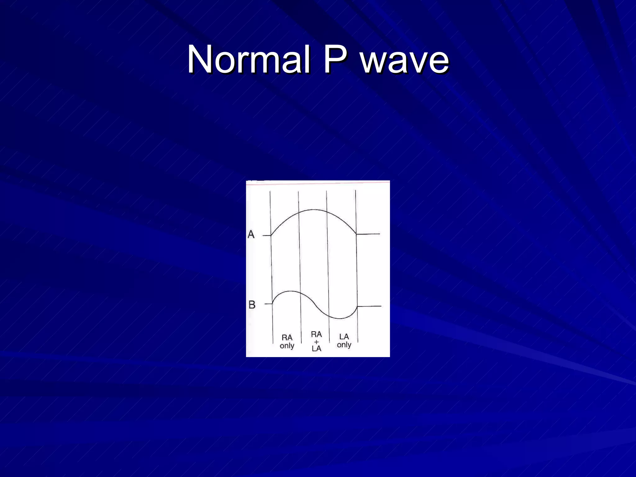 Normal P wave 