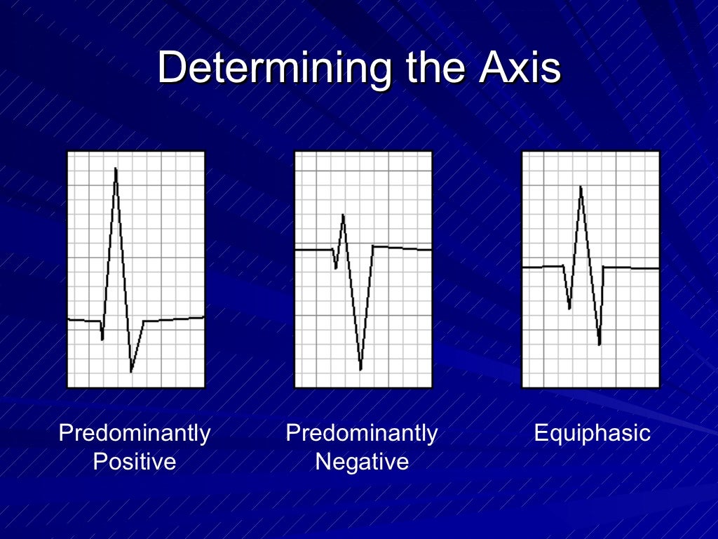 What Does An Ecg Involve