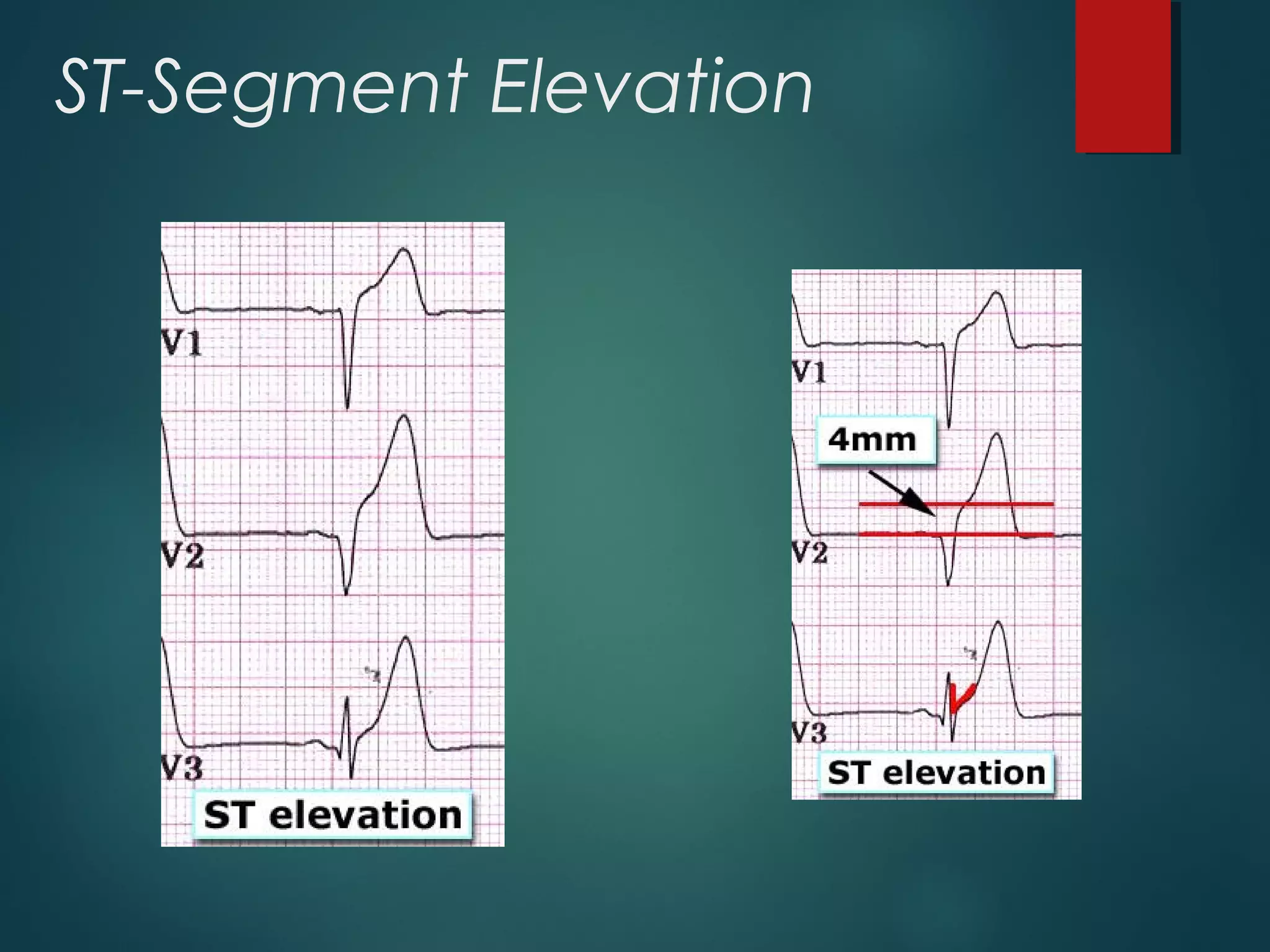 ST-Segment Elevation
 
