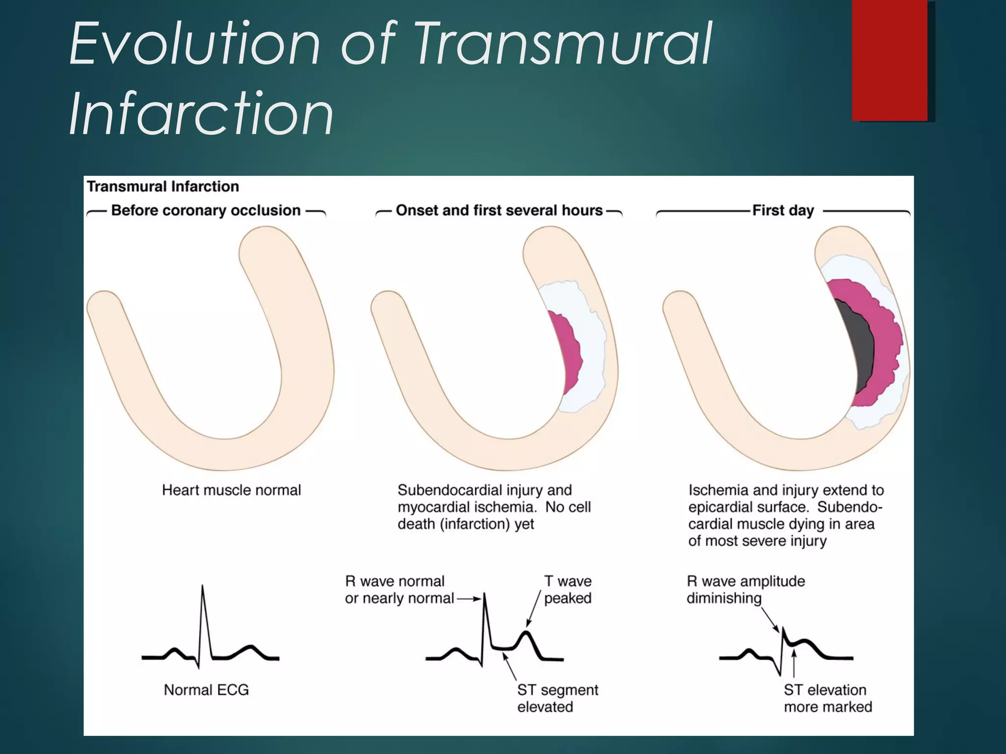 Evolution of Transmural
Infarction
 