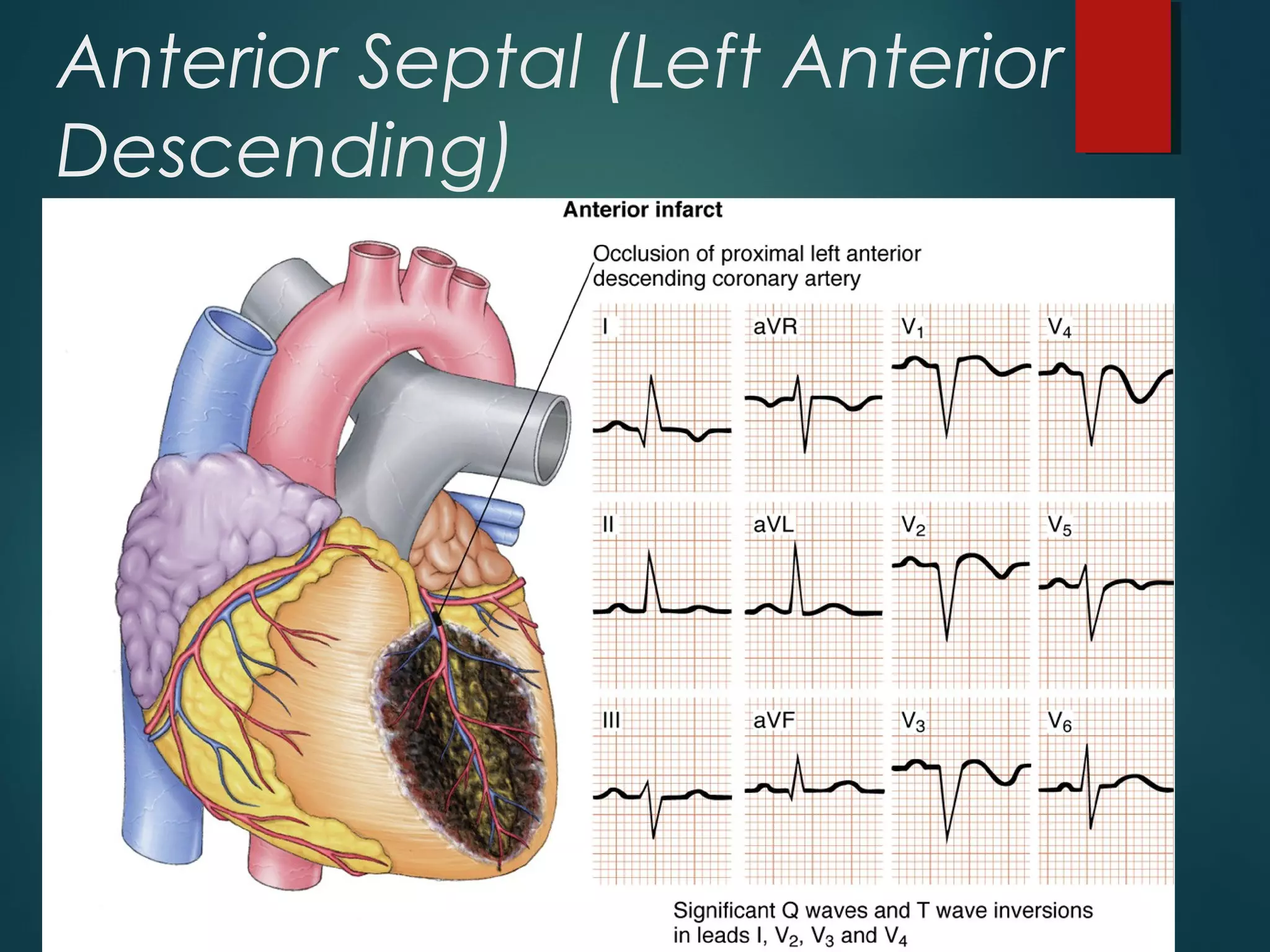 Anterior Septal (Left Anterior
Descending)
 