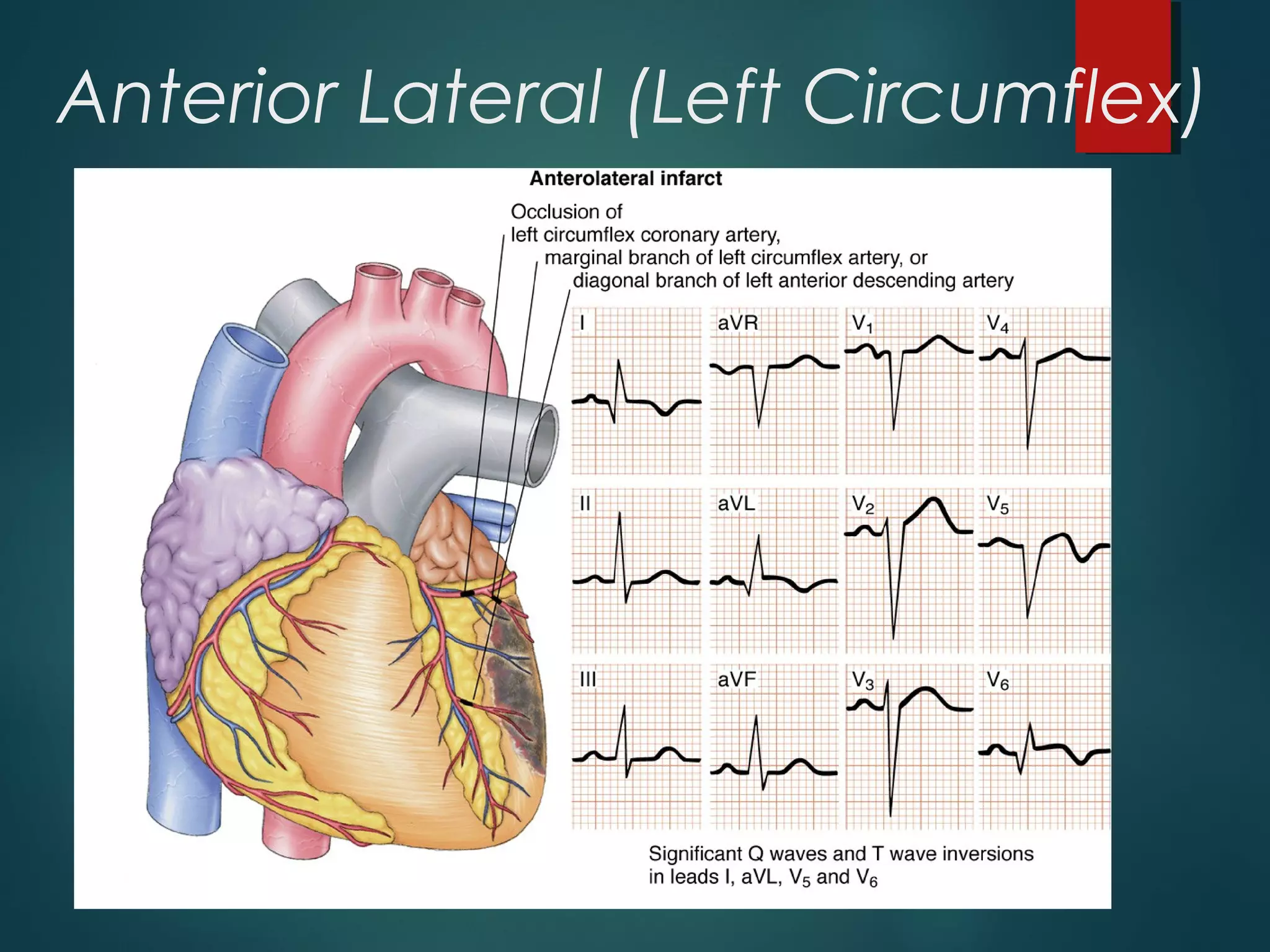 Anterior Lateral (Left Circumflex)
 