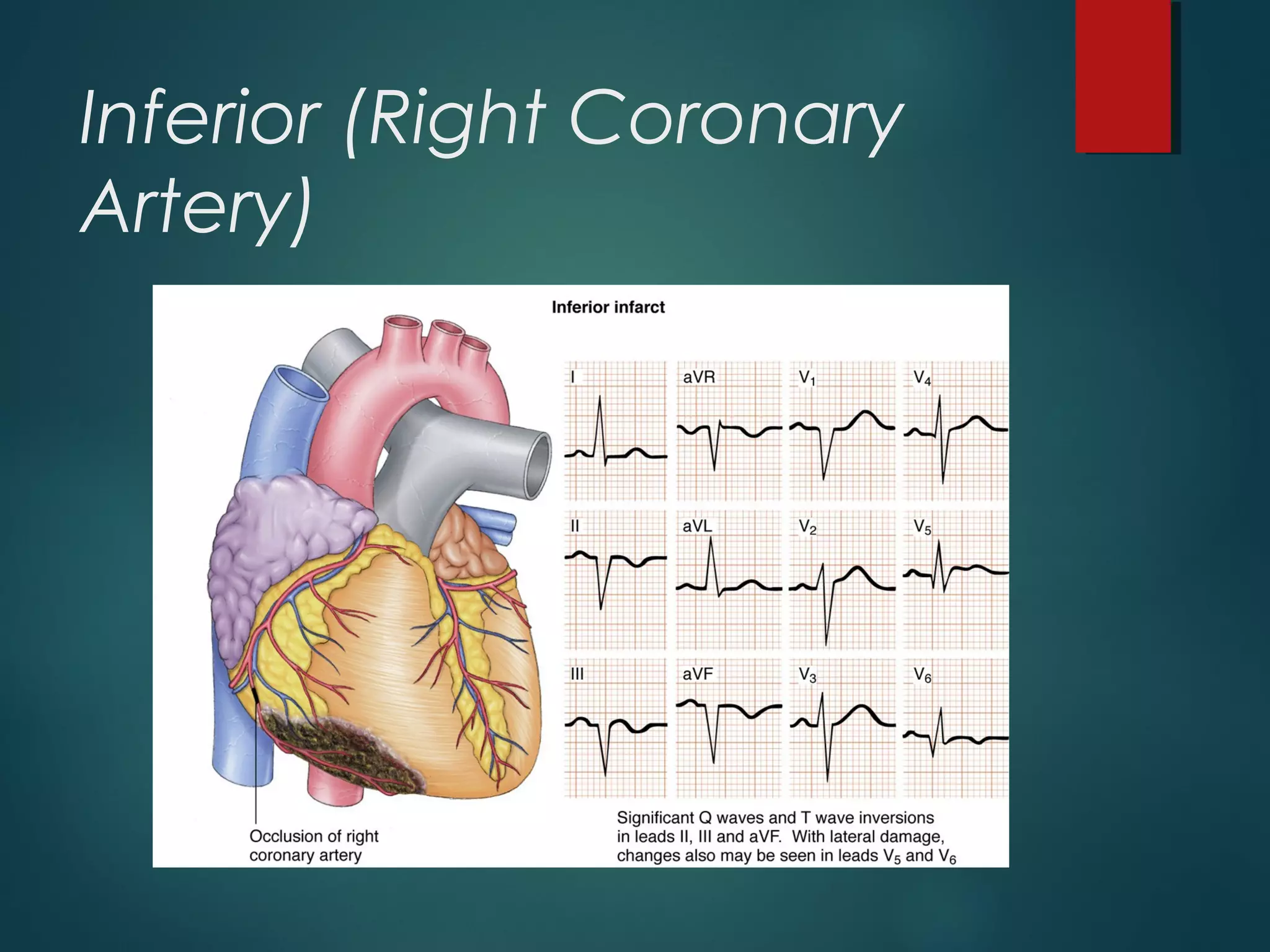 Inferior (Right Coronary
Artery)
 