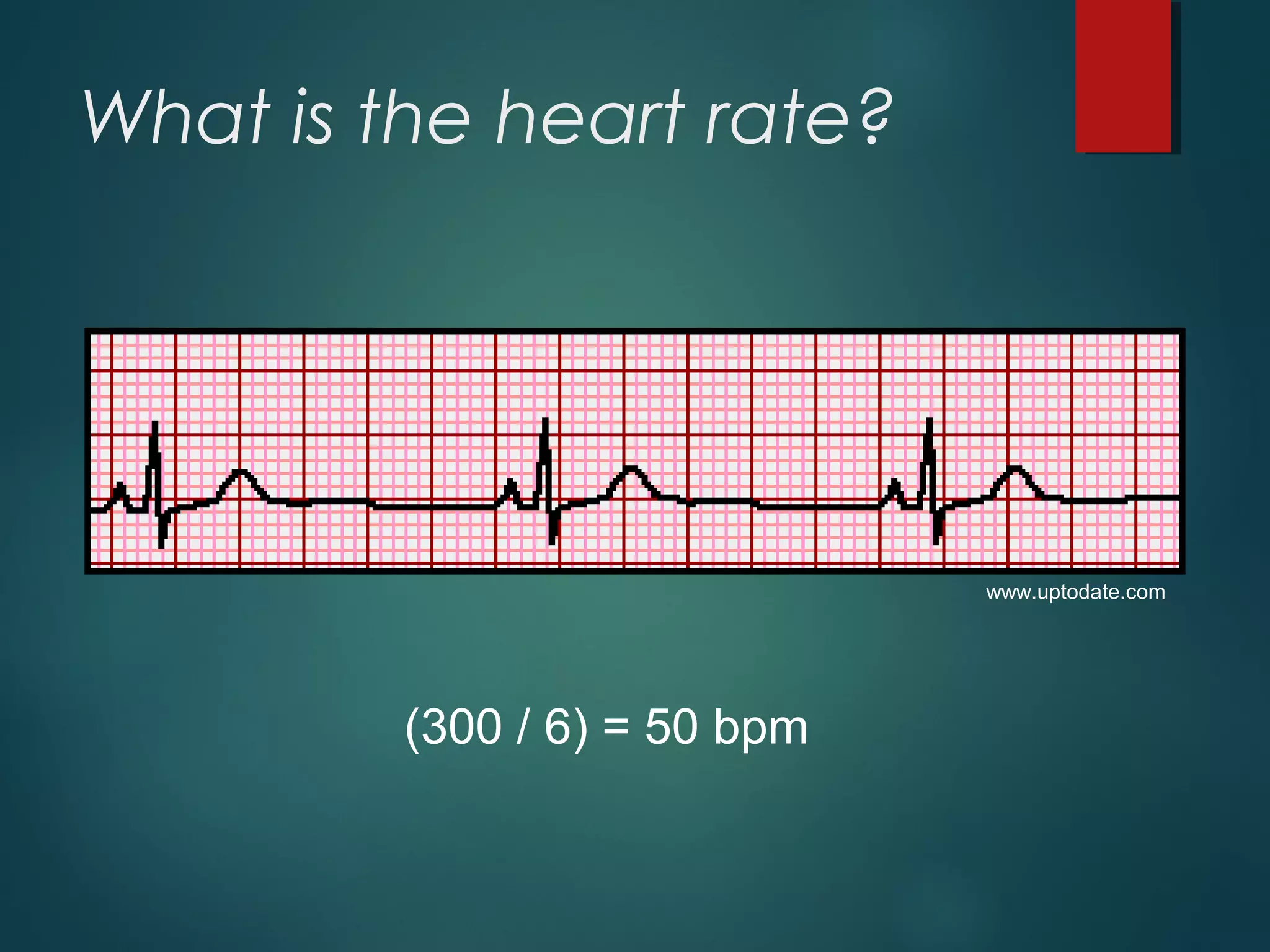 What is the heart rate?
(300 / 6) = 50 bpm
www.uptodate.com
 
