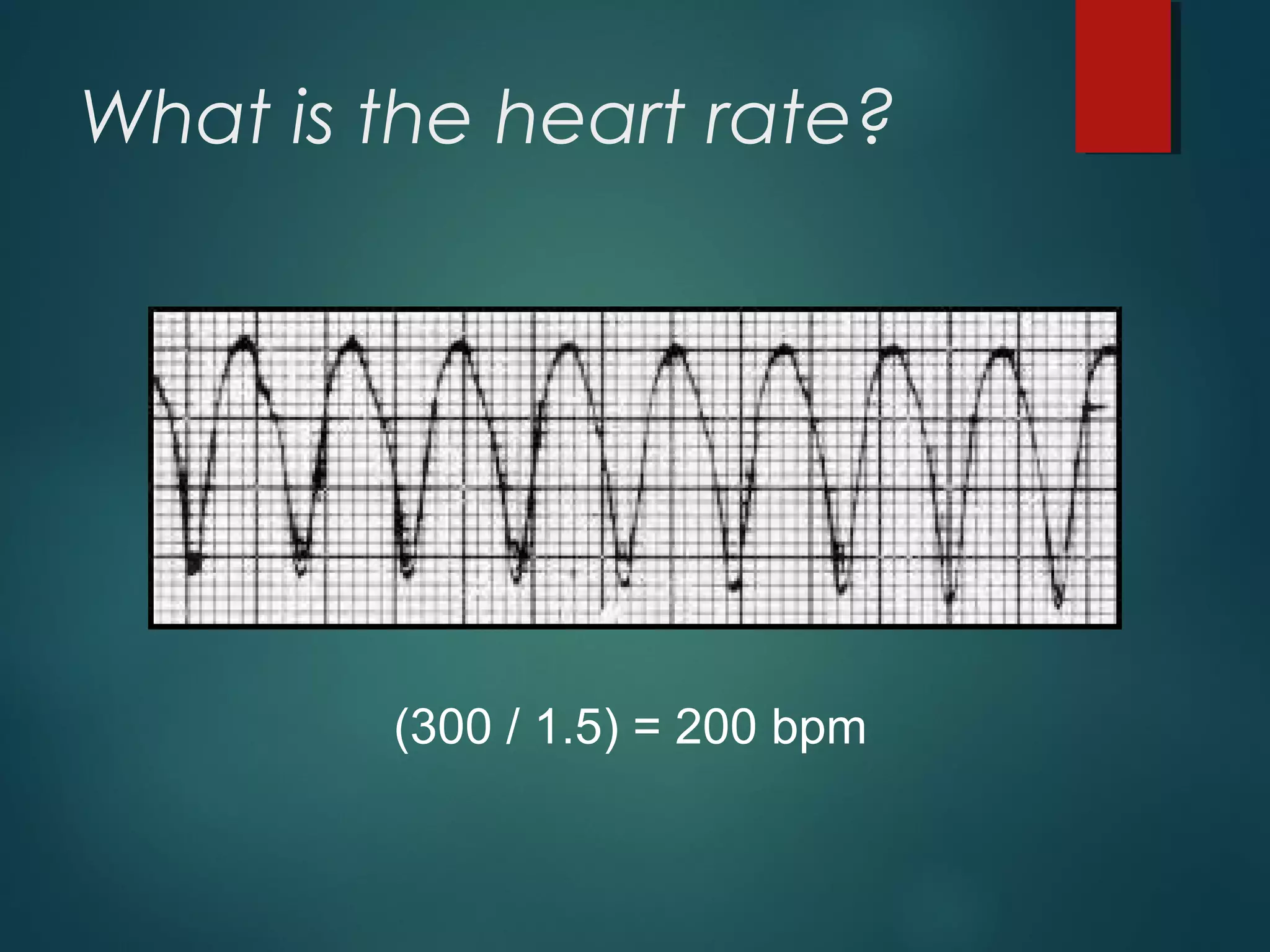What is the heart rate?
(300 / 1.5) = 200 bpm
 