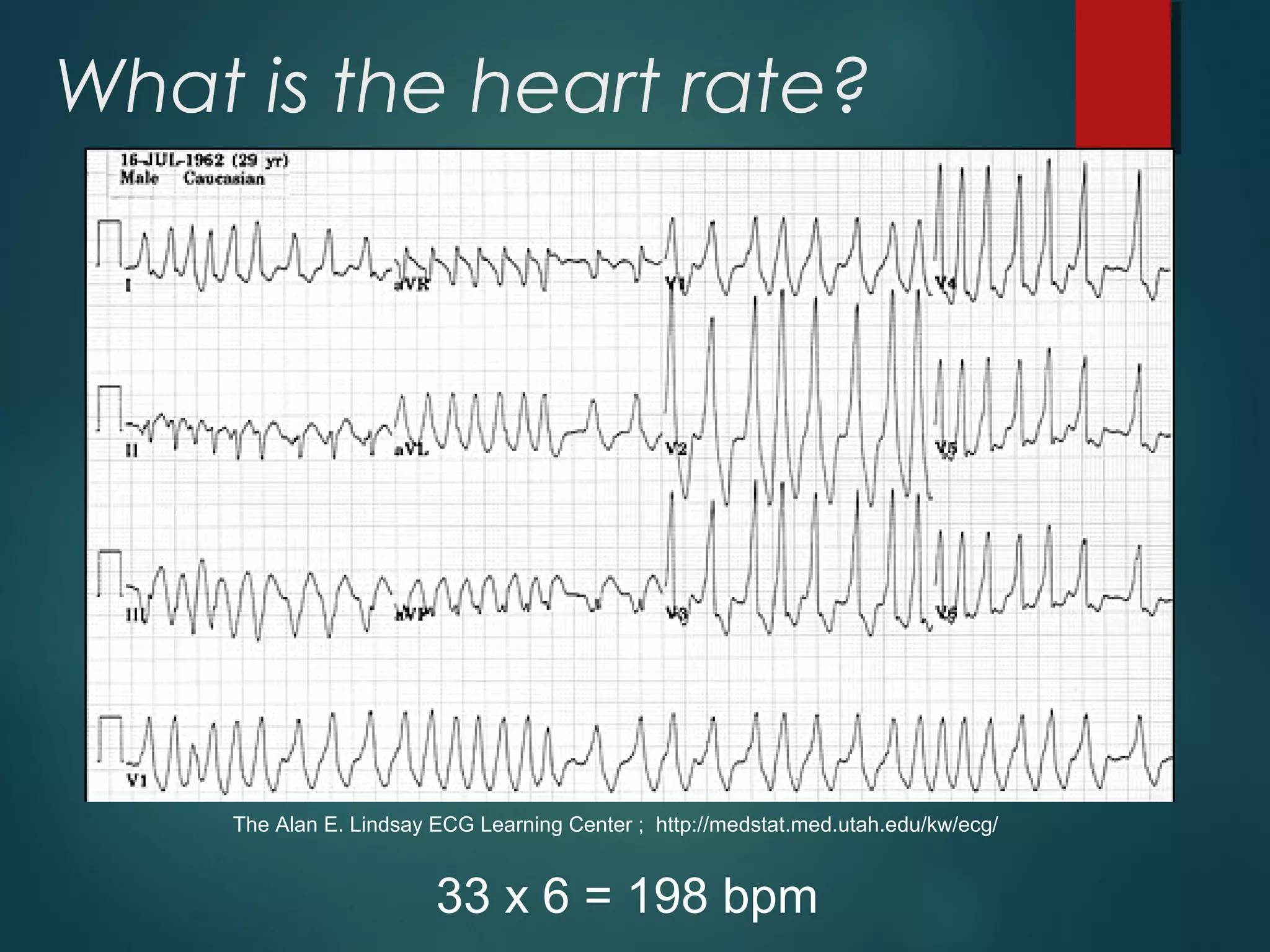 What is the heart rate?
33 x 6 = 198 bpm
The Alan E. Lindsay ECG Learning Center ; http://medstat.med.utah.edu/kw/ecg/
 