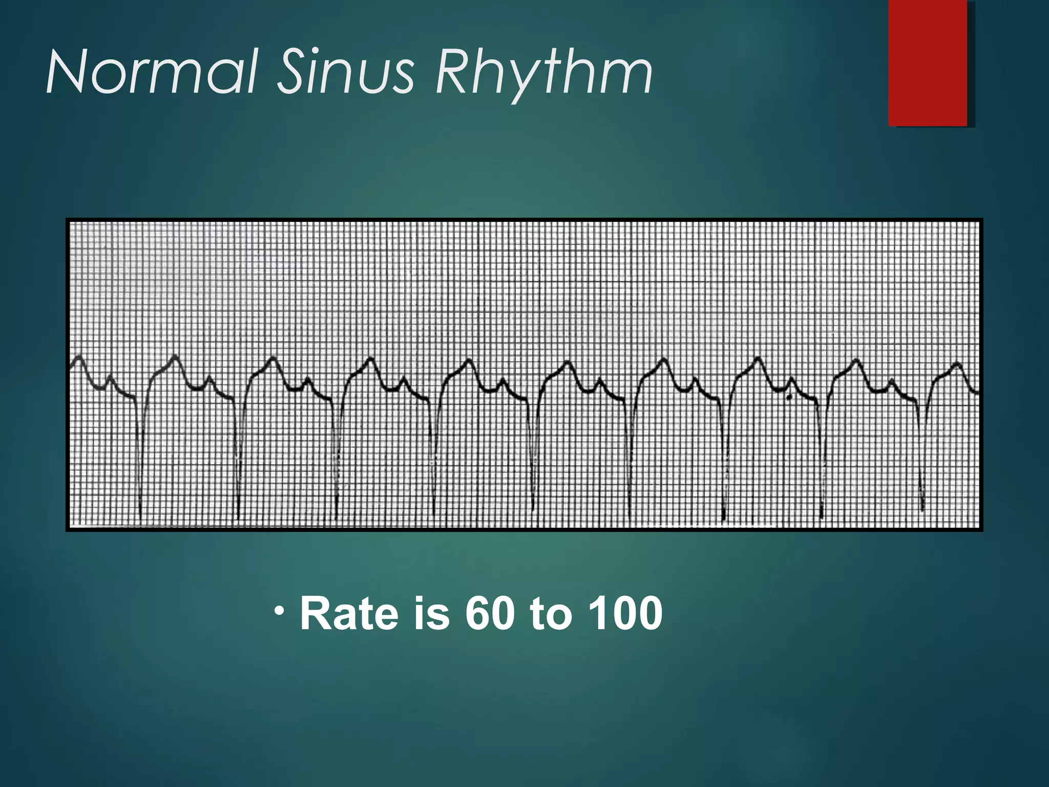 Normal Sinus Rhythm
• Rate is 60 to 100
 