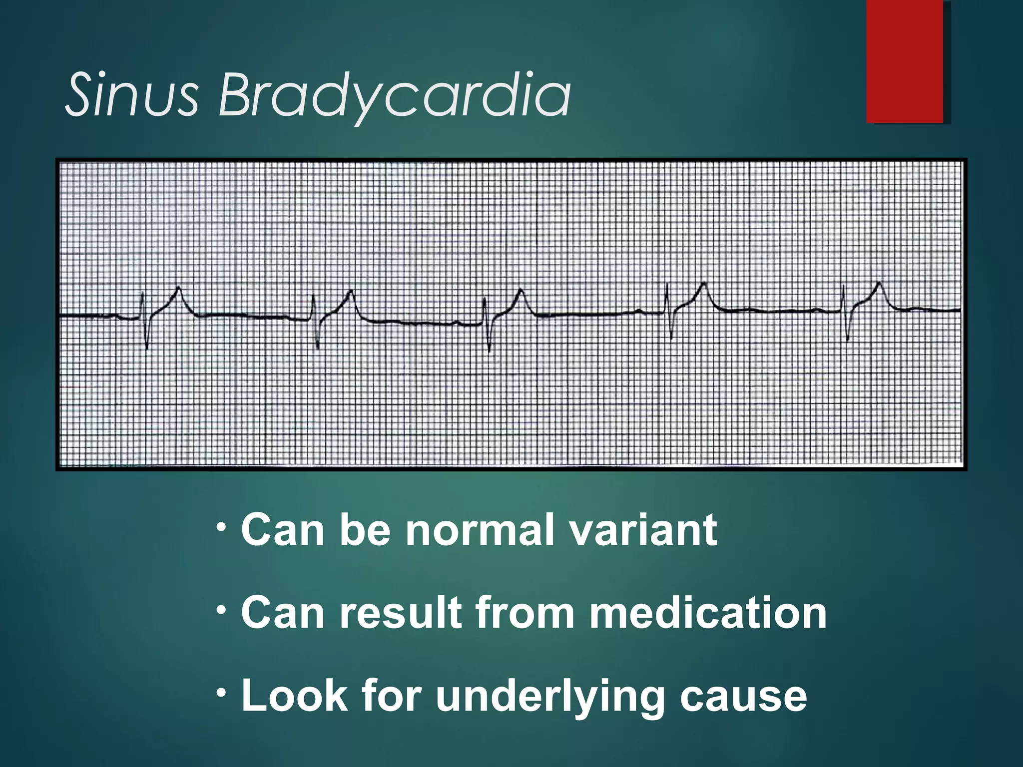 Sinus Bradycardia
• Can be normal variant
• Can result from medication
• Look for underlying cause
 