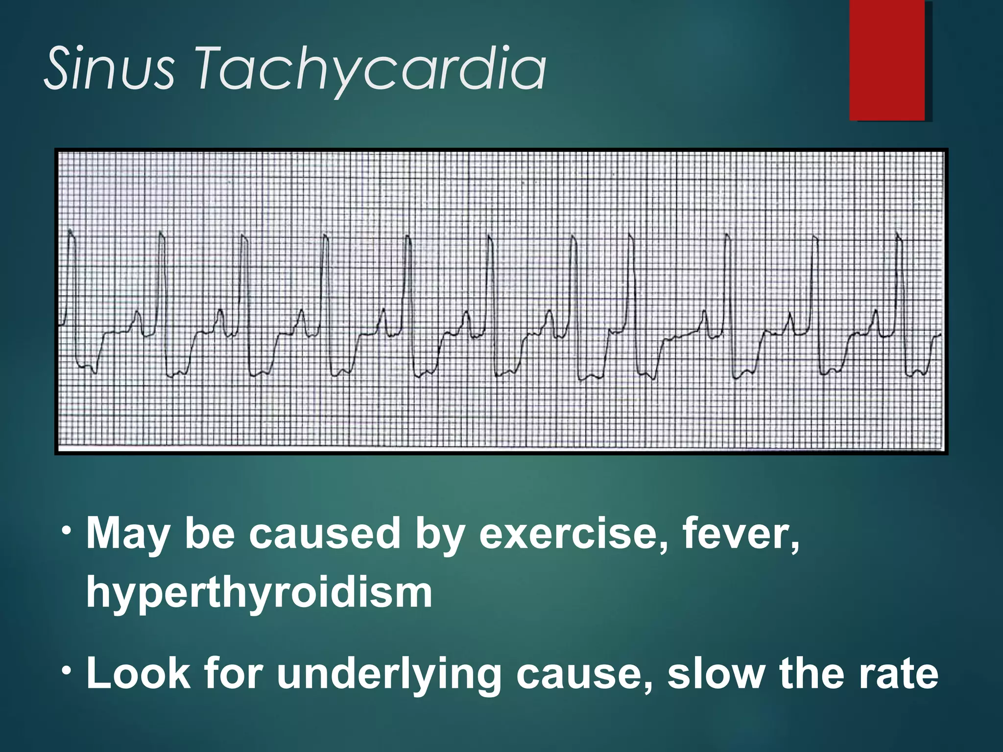 Sinus Tachycardia
• May be caused by exercise, fever,
hyperthyroidism
• Look for underlying cause, slow the rate
 