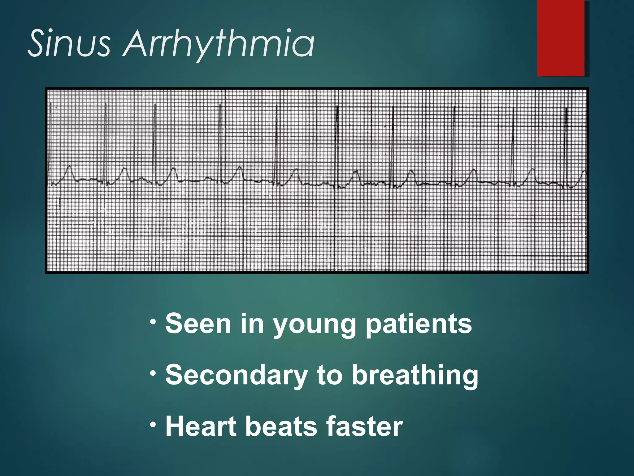 Sinus Arrhythmia
• Seen in young patients
• Secondary to breathing
• Heart beats faster
 