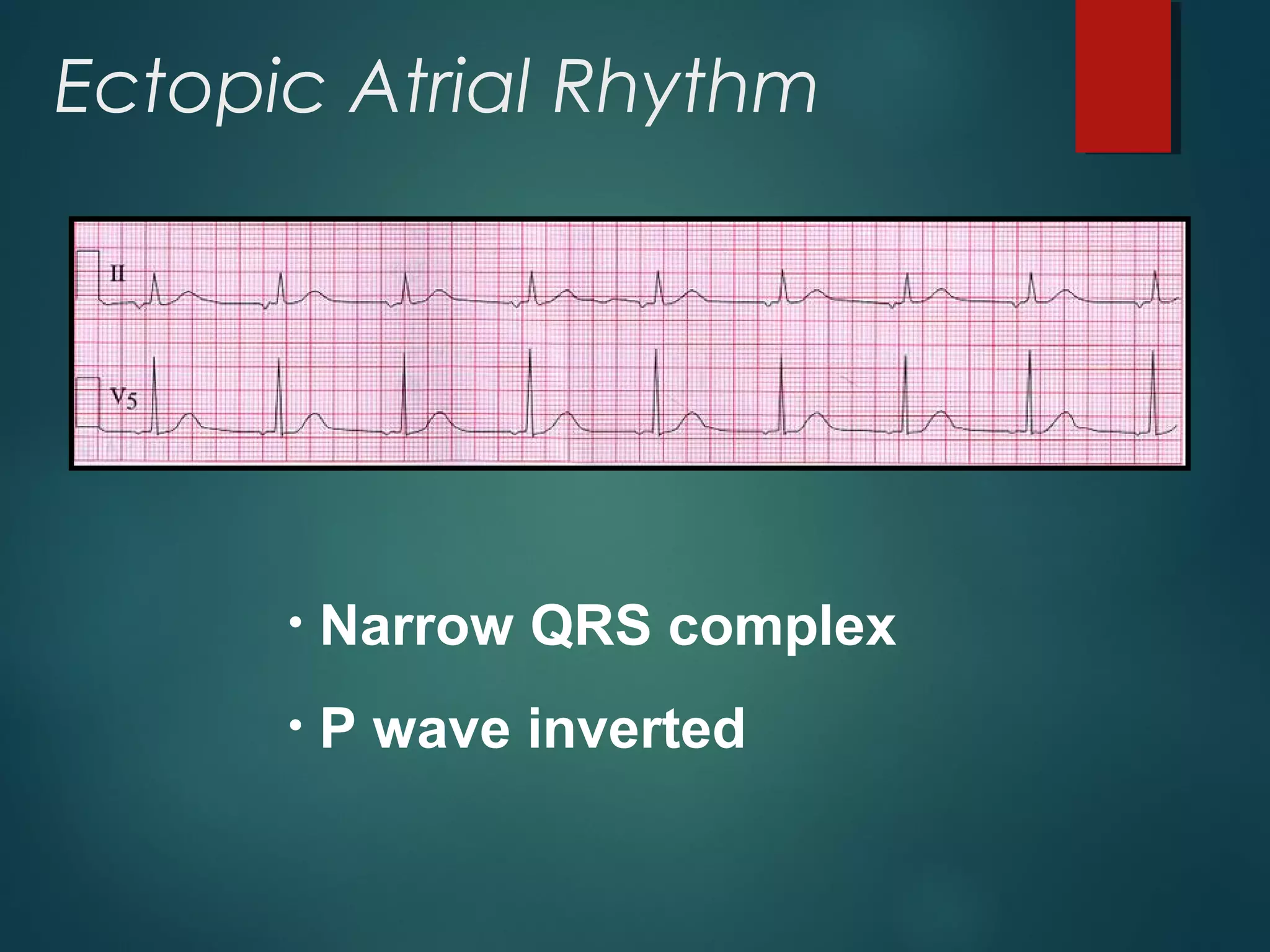 Ectopic Atrial Rhythm
• Narrow QRS complex
• P wave inverted
 