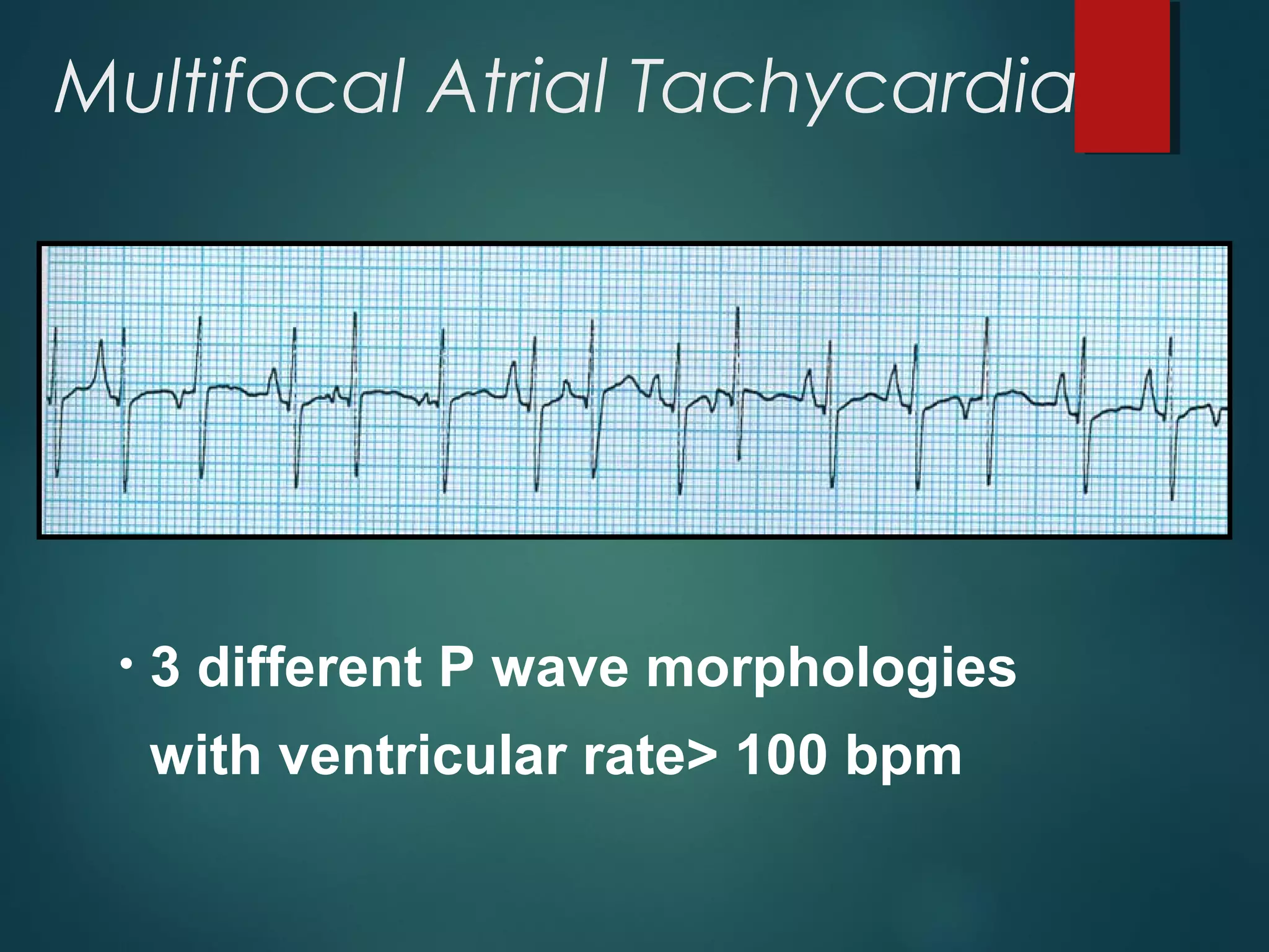 Multifocal Atrial Tachycardia
• 3 different P wave morphologies
with ventricular rate> 100 bpm
 