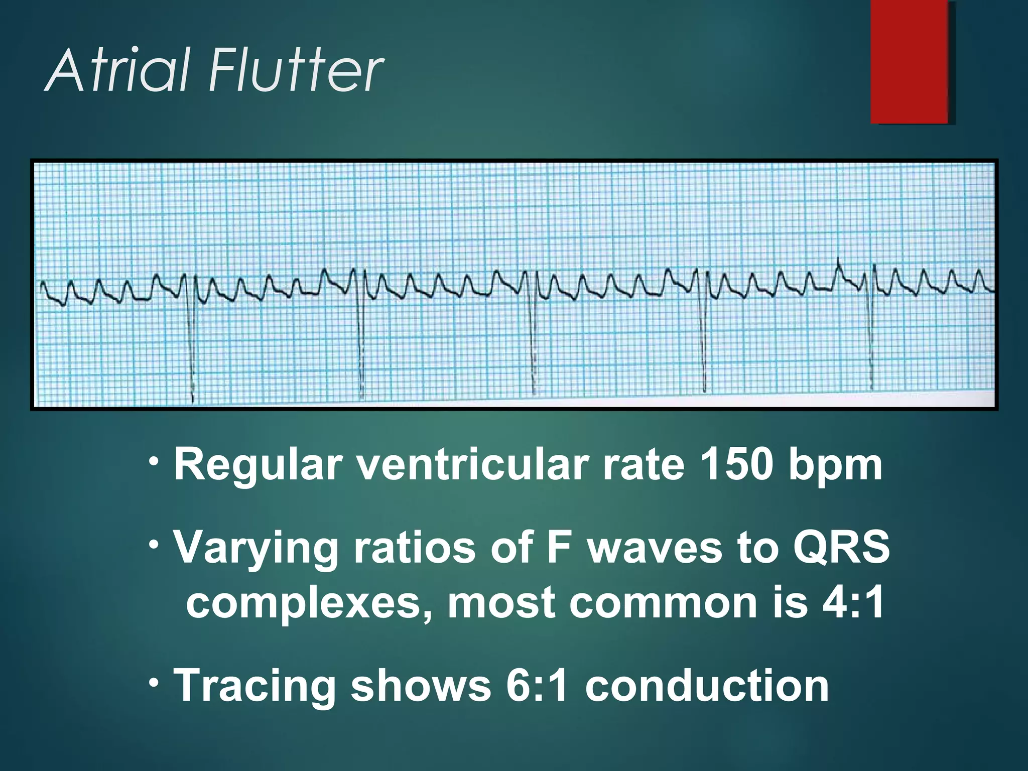 Atrial Flutter
• Regular ventricular rate 150 bpm
• Varying ratios of F waves to QRS
complexes, most common is 4:1
• Tracing shows 6:1 conduction
 