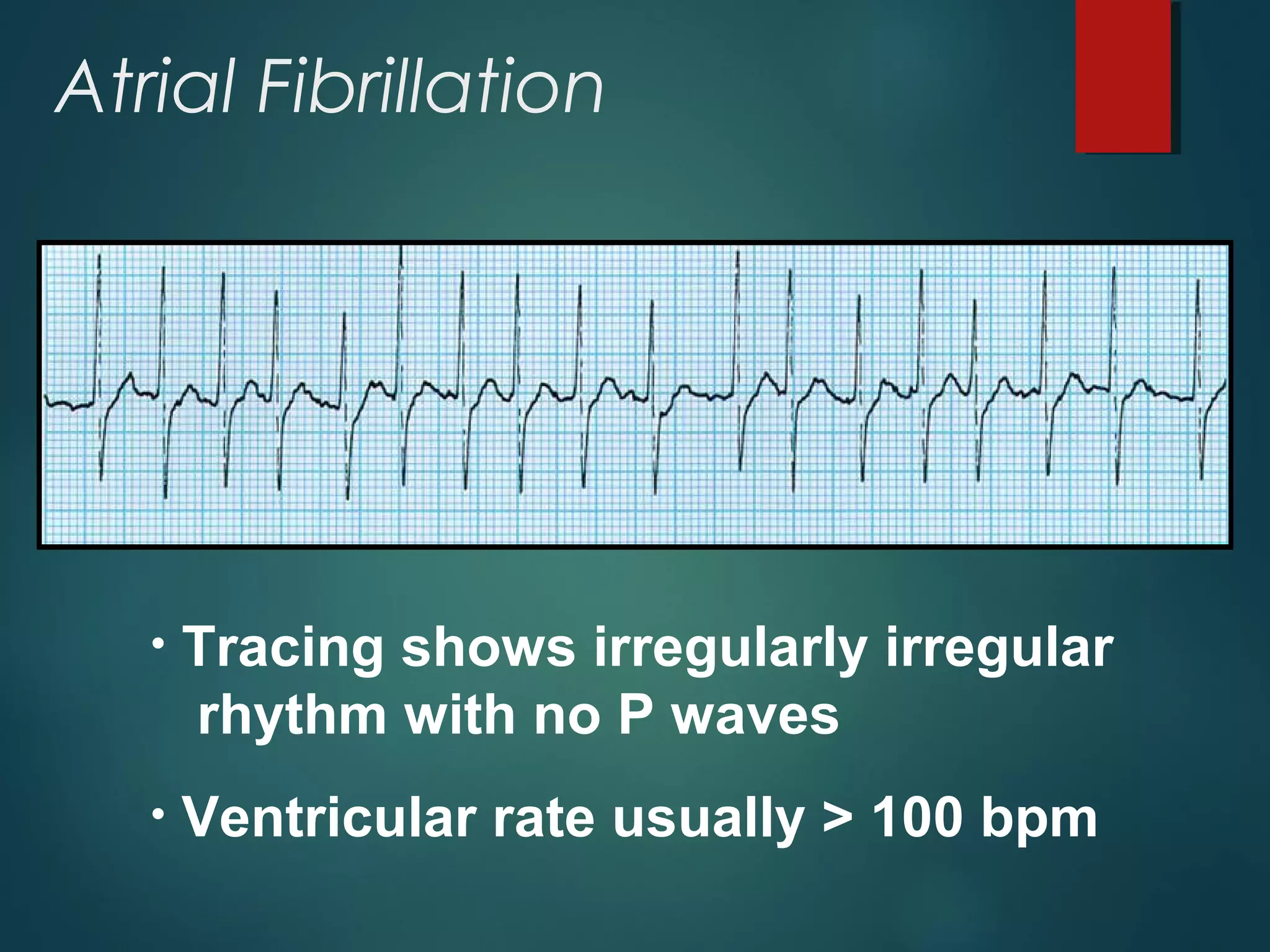 Atrial Fibrillation
• Tracing shows irregularly irregular
rhythm with no P waves
• Ventricular rate usually > 100 bpm
 