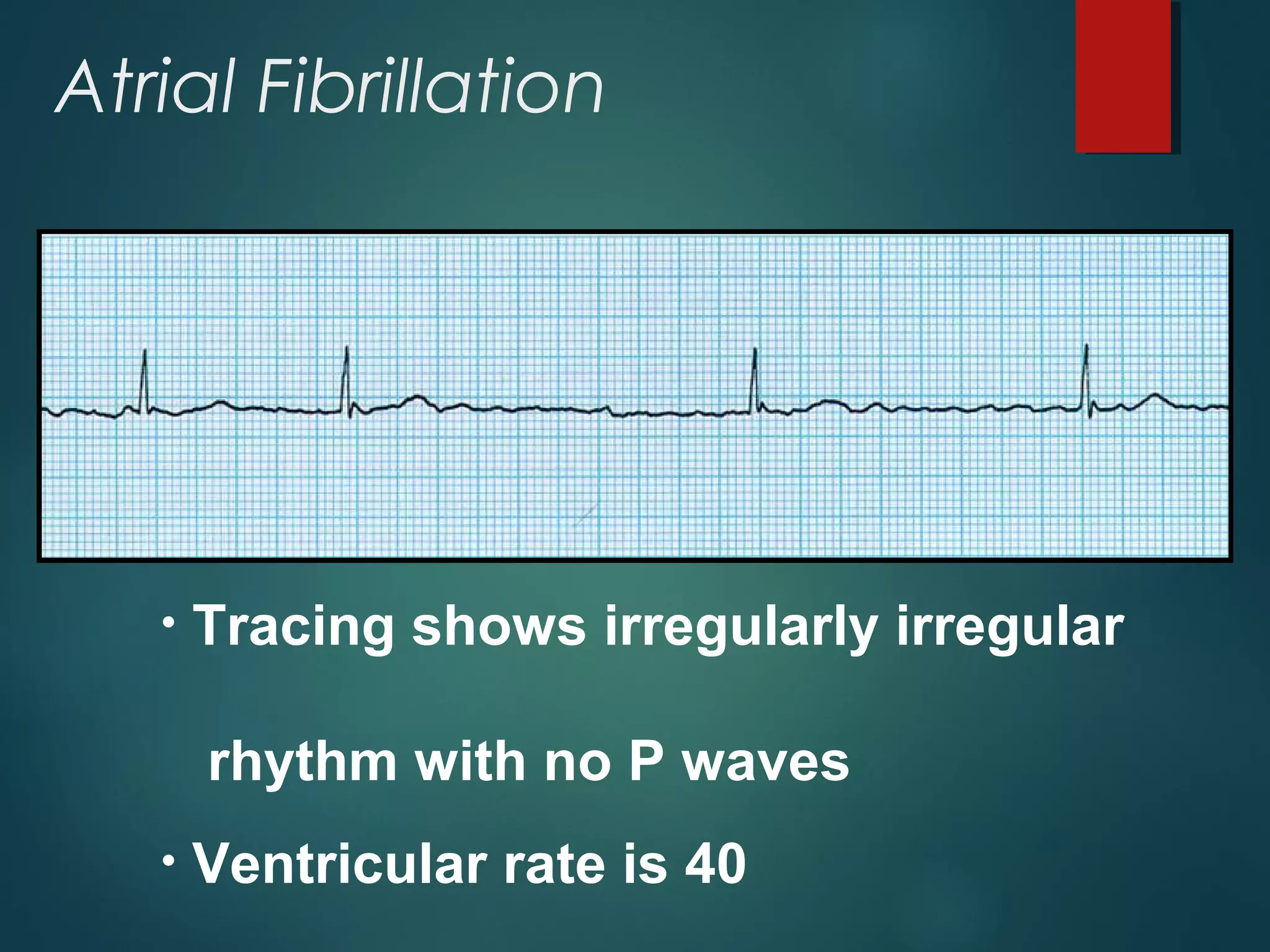 Atrial Fibrillation
• Tracing shows irregularly irregular
rhythm with no P waves
• Ventricular rate is 40
 