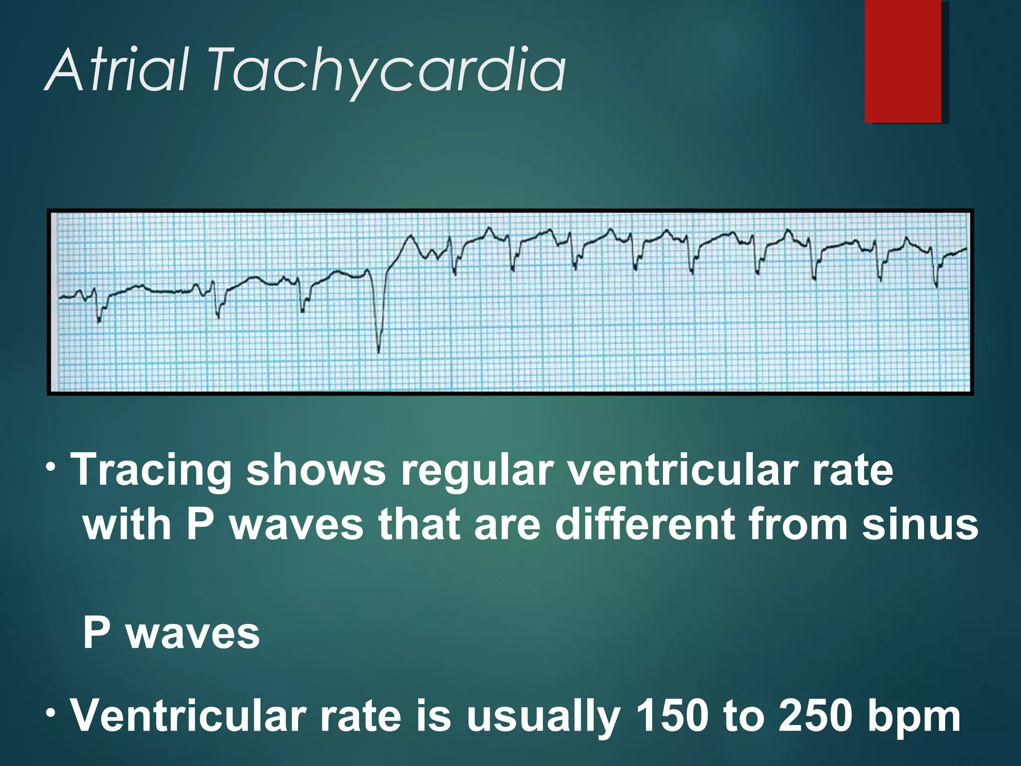 Atrial Tachycardia
• Tracing shows regular ventricular rate
with P waves that are different from sinus
P waves
• Ventricular rate is usually 150 to 250 bpm
 