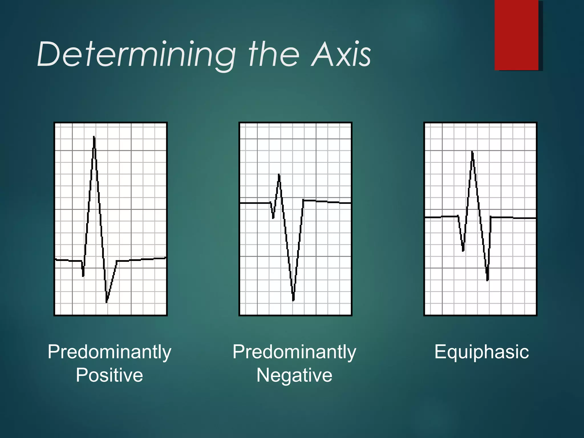 Determining the Axis
Predominantly
Positive
Predominantly
Negative
Equiphasic
 