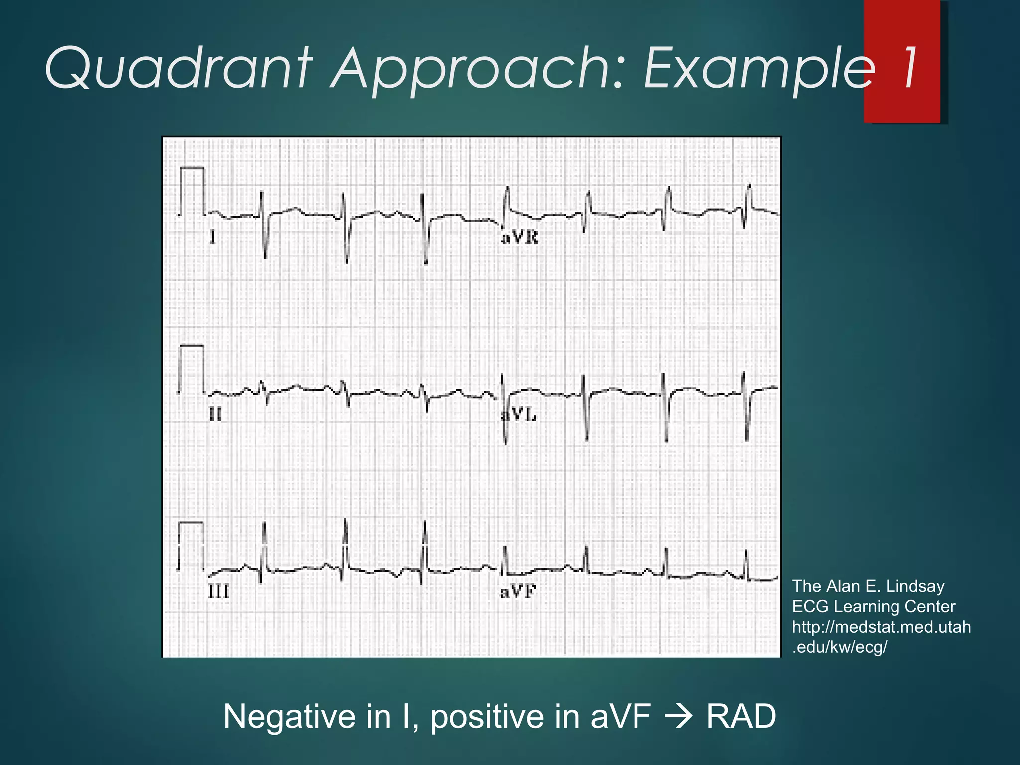 Quadrant Approach: Example 1
Negative in I, positive in aVF  RAD
The Alan E. Lindsay
ECG Learning Center
http://medstat.med.utah
.edu/kw/ecg/
 