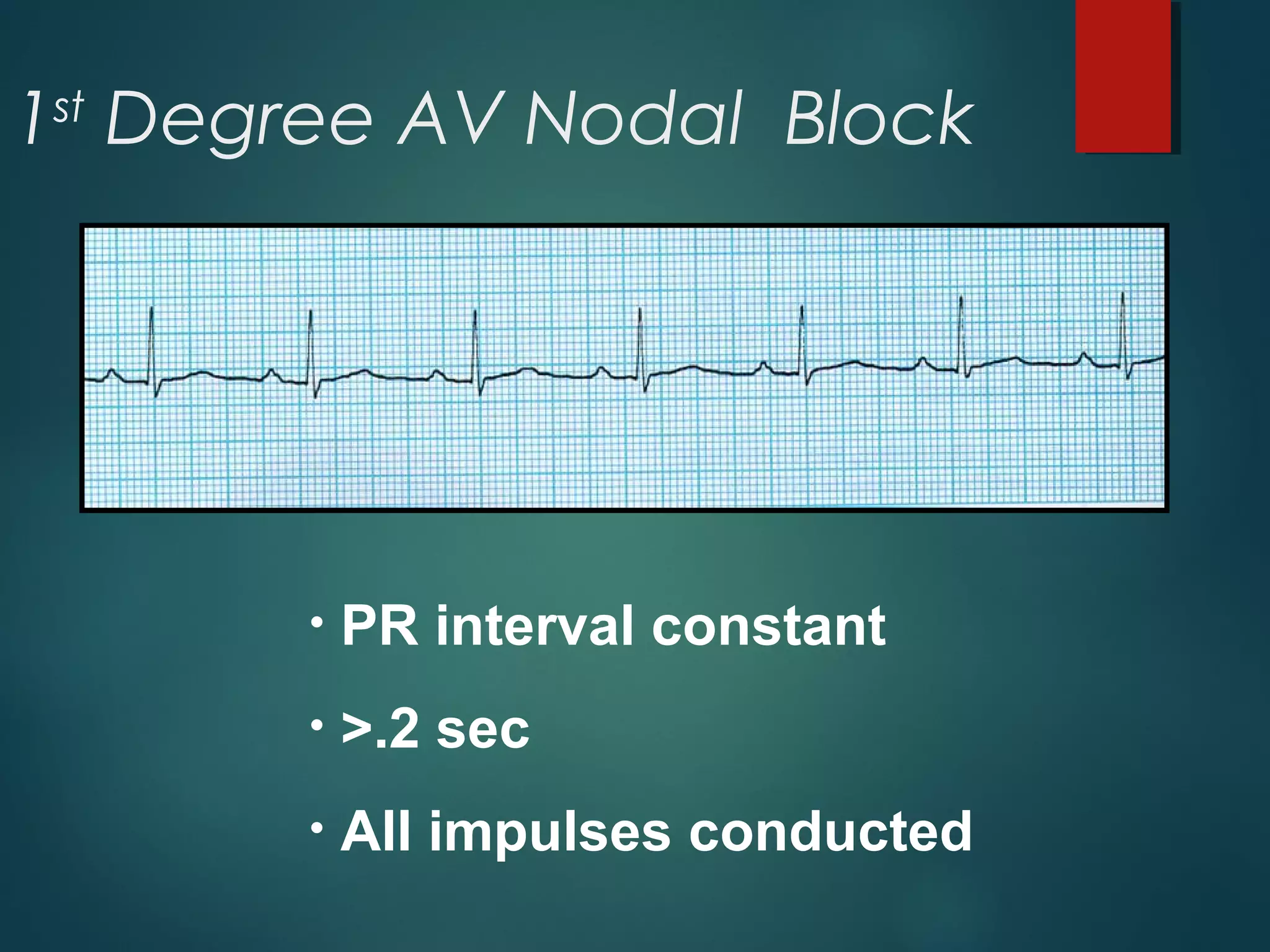 1st
Degree AV Nodal Block
• PR interval constant
• >.2 sec
• All impulses conducted
 