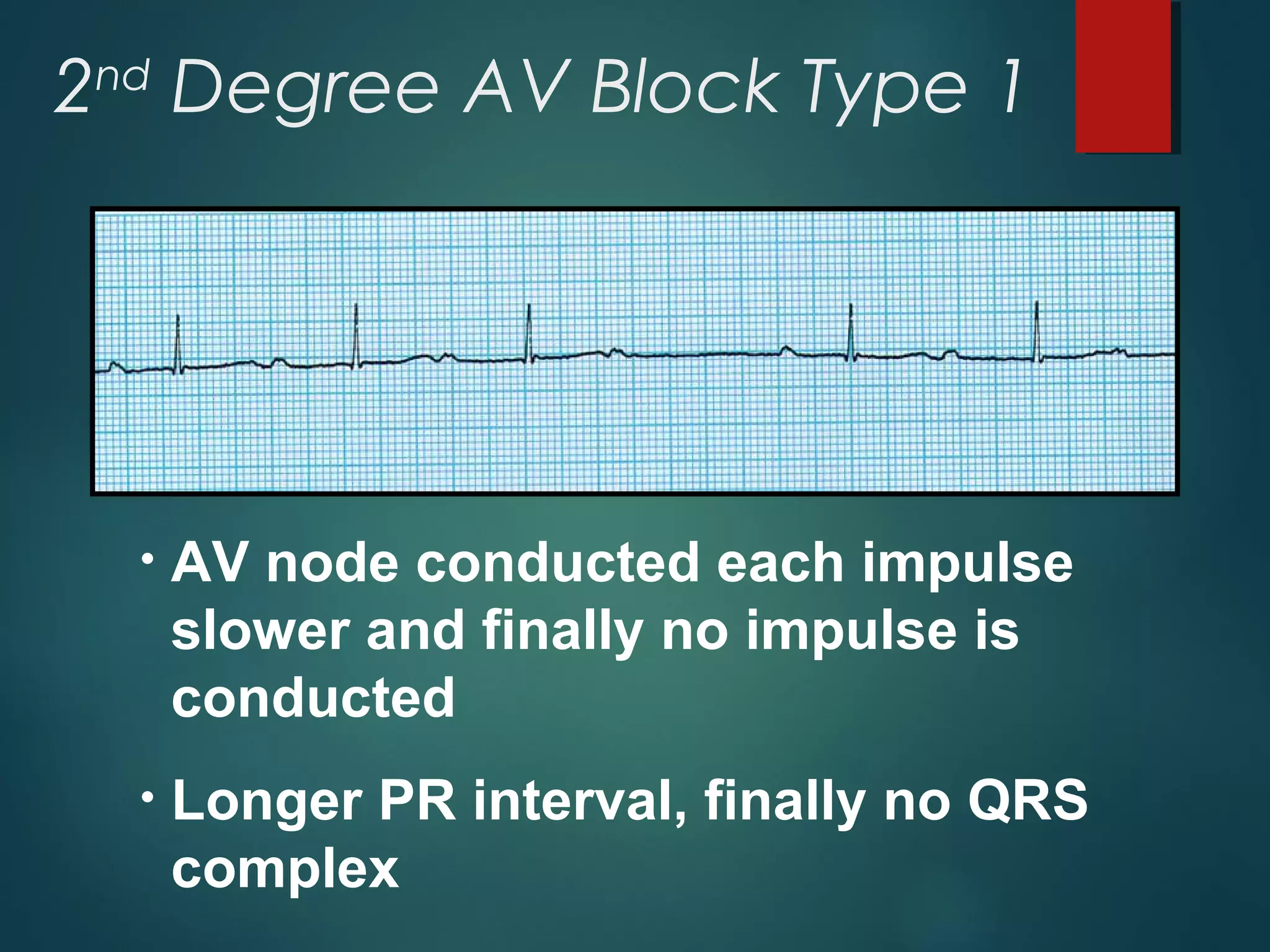 2nd
Degree AV Block Type 1
• AV node conducted each impulse
slower and finally no impulse is
conducted
• Longer PR interval, finally no QRS
complex
 