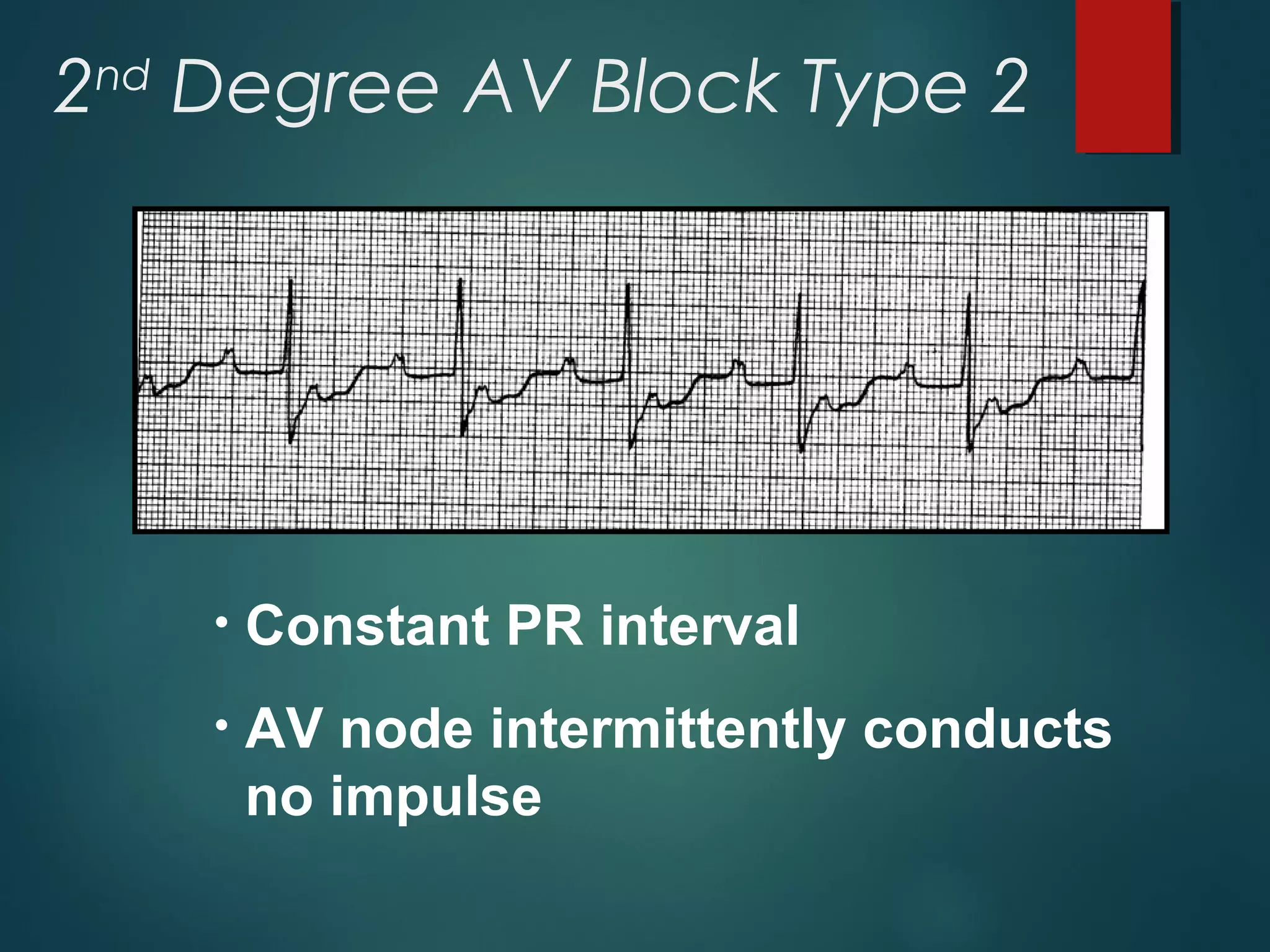 2nd
Degree AV Block Type 2
• Constant PR interval
• AV node intermittently conducts
no impulse
 