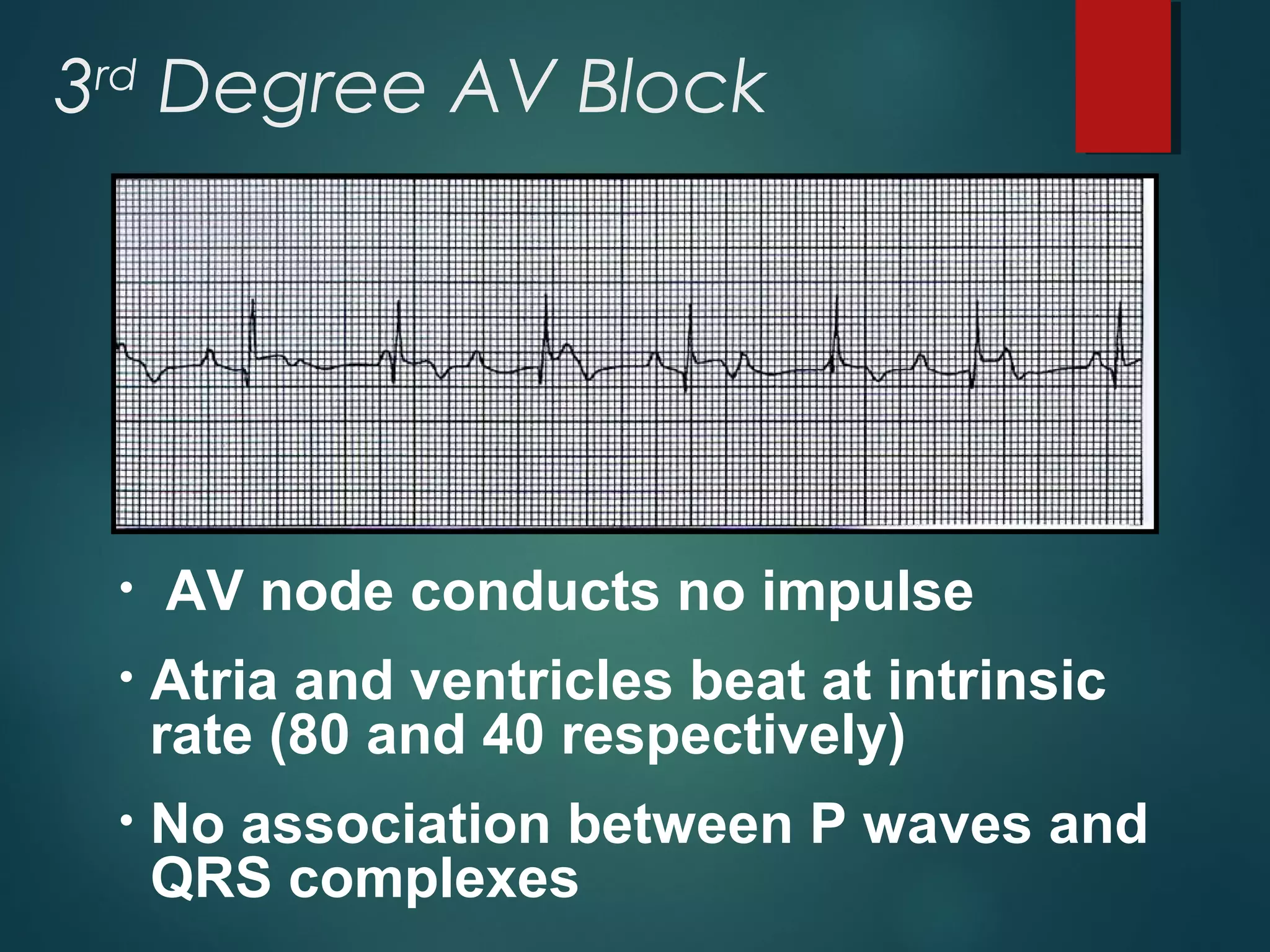 • AV node conducts no impulse
• Atria and ventricles beat at intrinsic
rate (80 and 40 respectively)
• No association between P waves and
QRS complexes
3rd
Degree AV Block
 