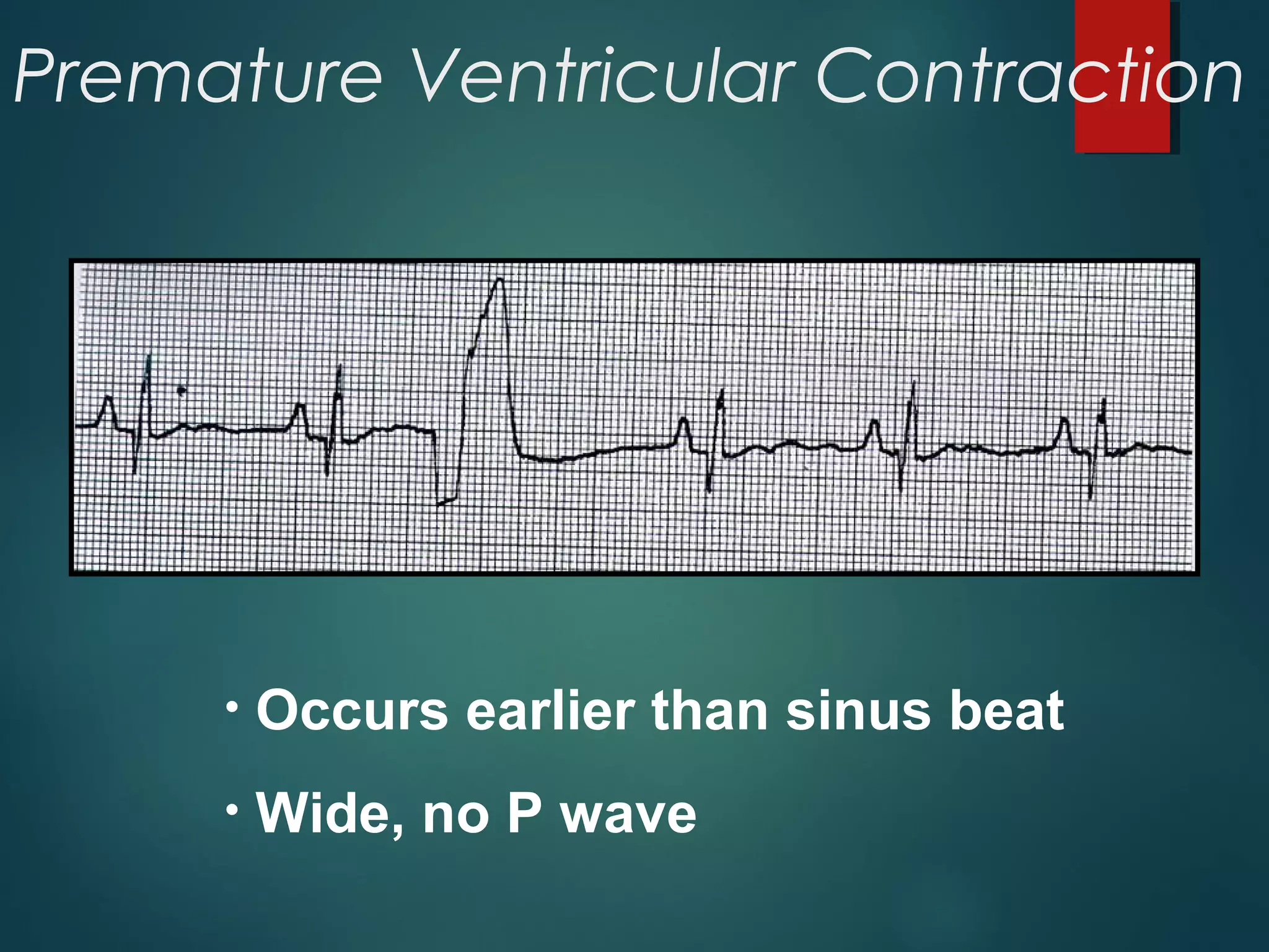 Premature Ventricular Contraction
• Occurs earlier than sinus beat
• Wide, no P wave
 