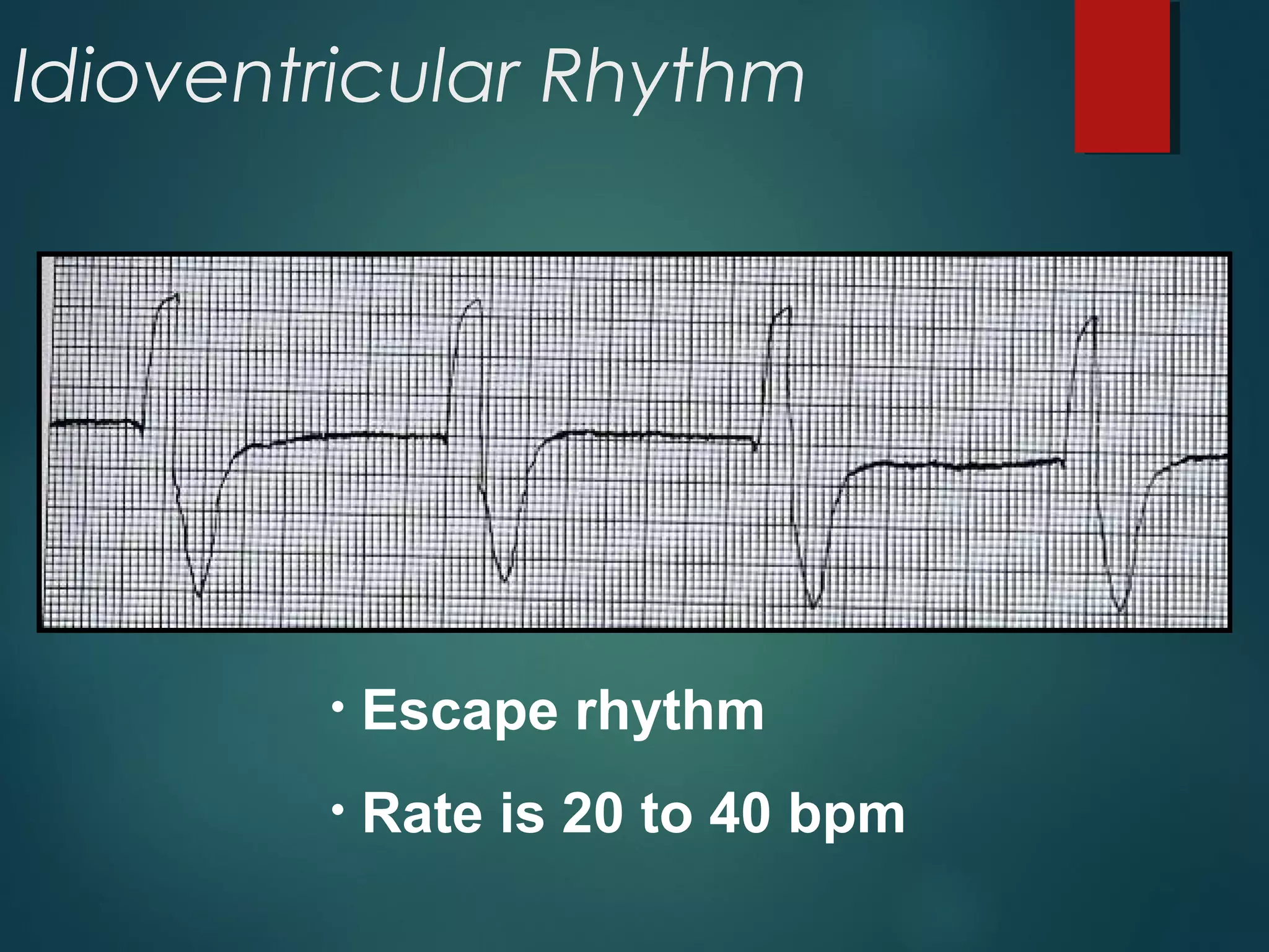 Idioventricular Rhythm
• Escape rhythm
• Rate is 20 to 40 bpm
 