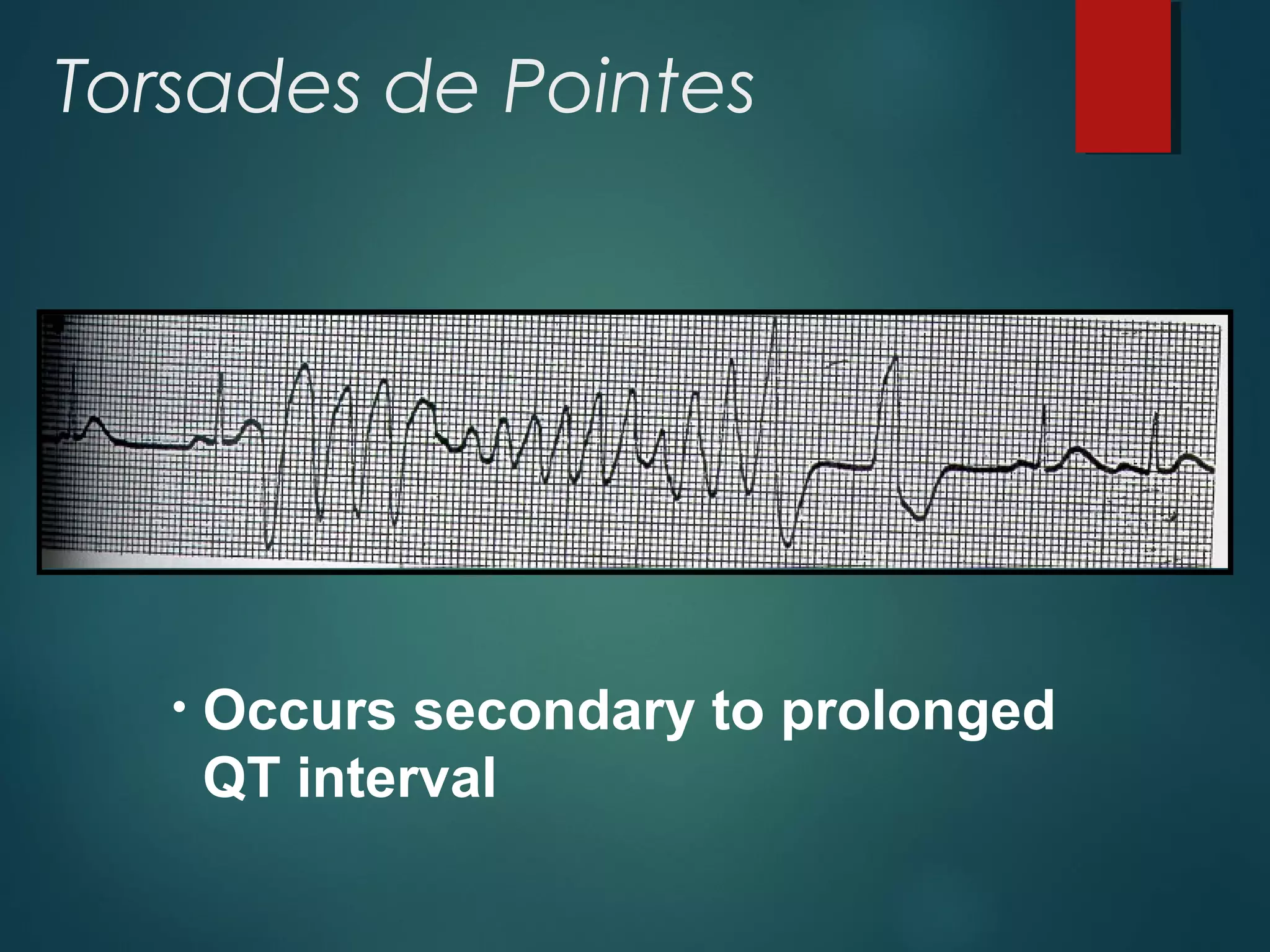 Torsades de Pointes
• Occurs secondary to prolonged
QT interval
 