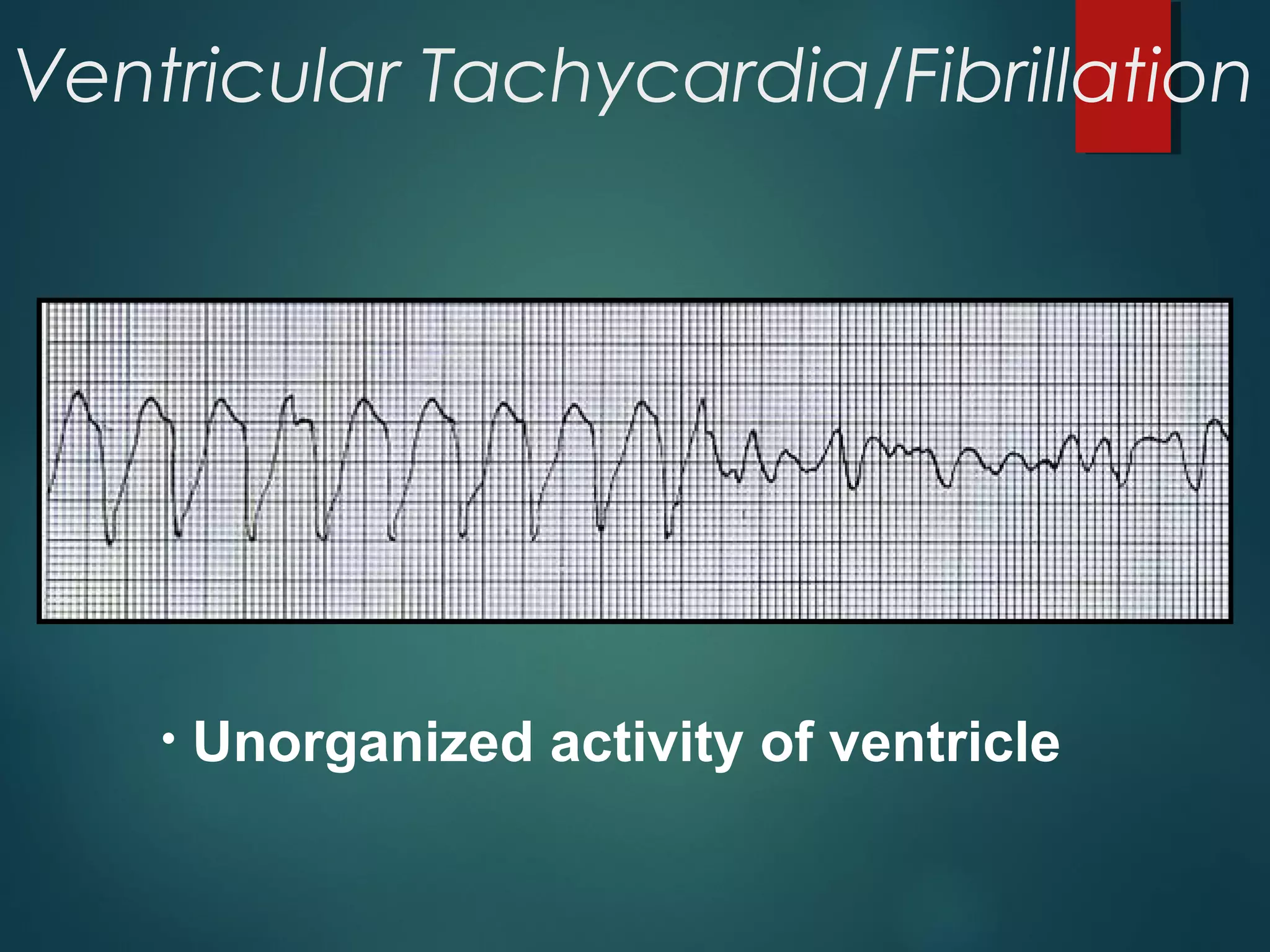 Ventricular Tachycardia/Fibrillation
• Unorganized activity of ventricle
 