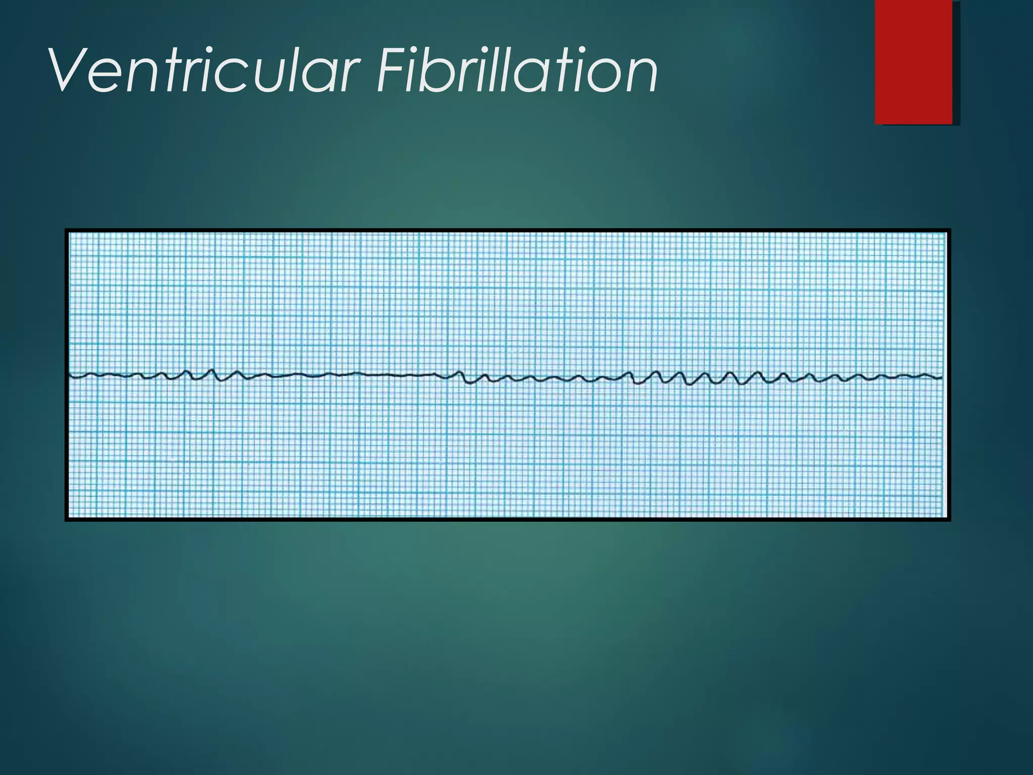 Ventricular Fibrillation
 