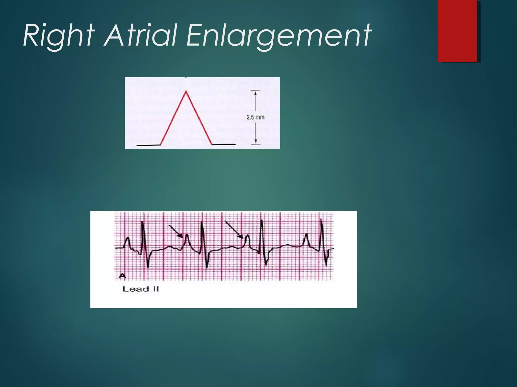 Right Atrial Enlargement
 