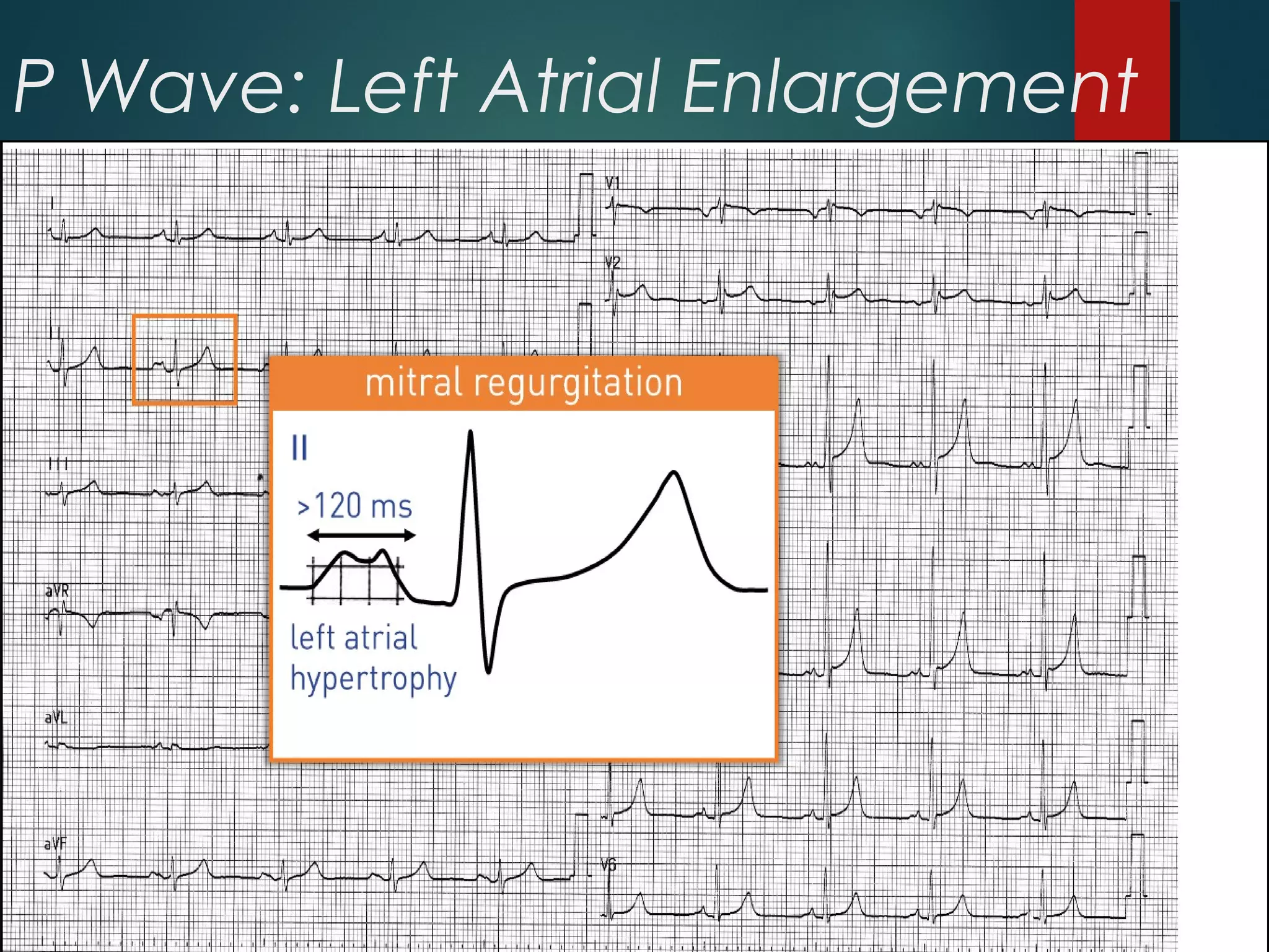 P Wave: Left Atrial Enlargement
 
