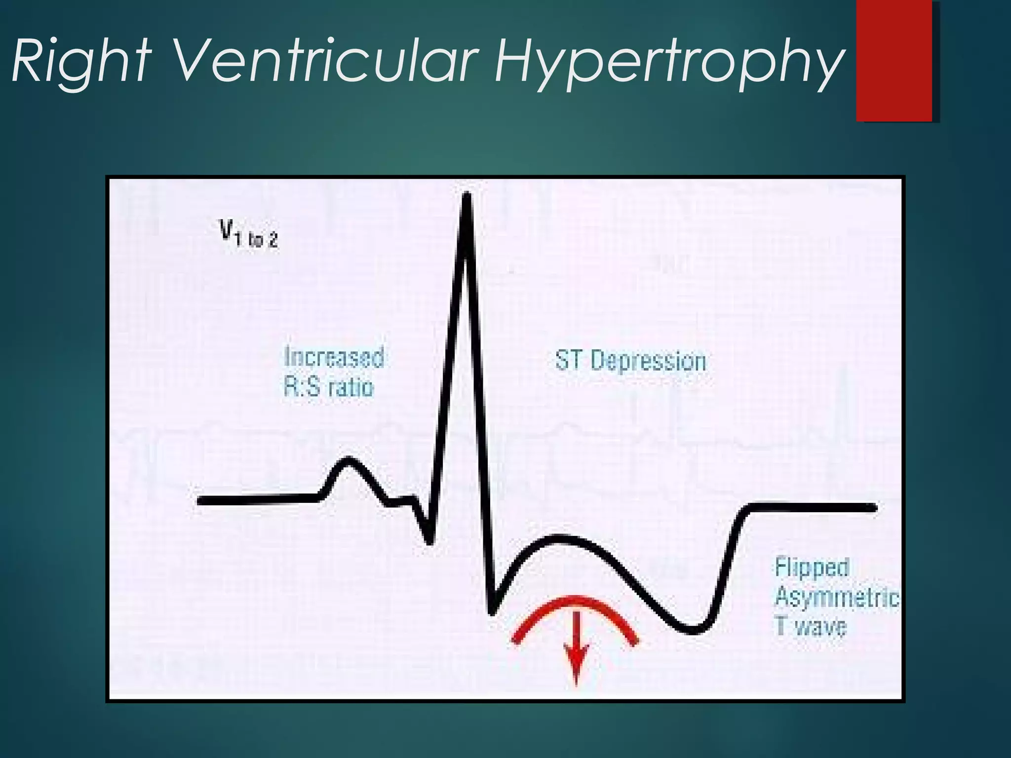 Right Ventricular Hypertrophy
 