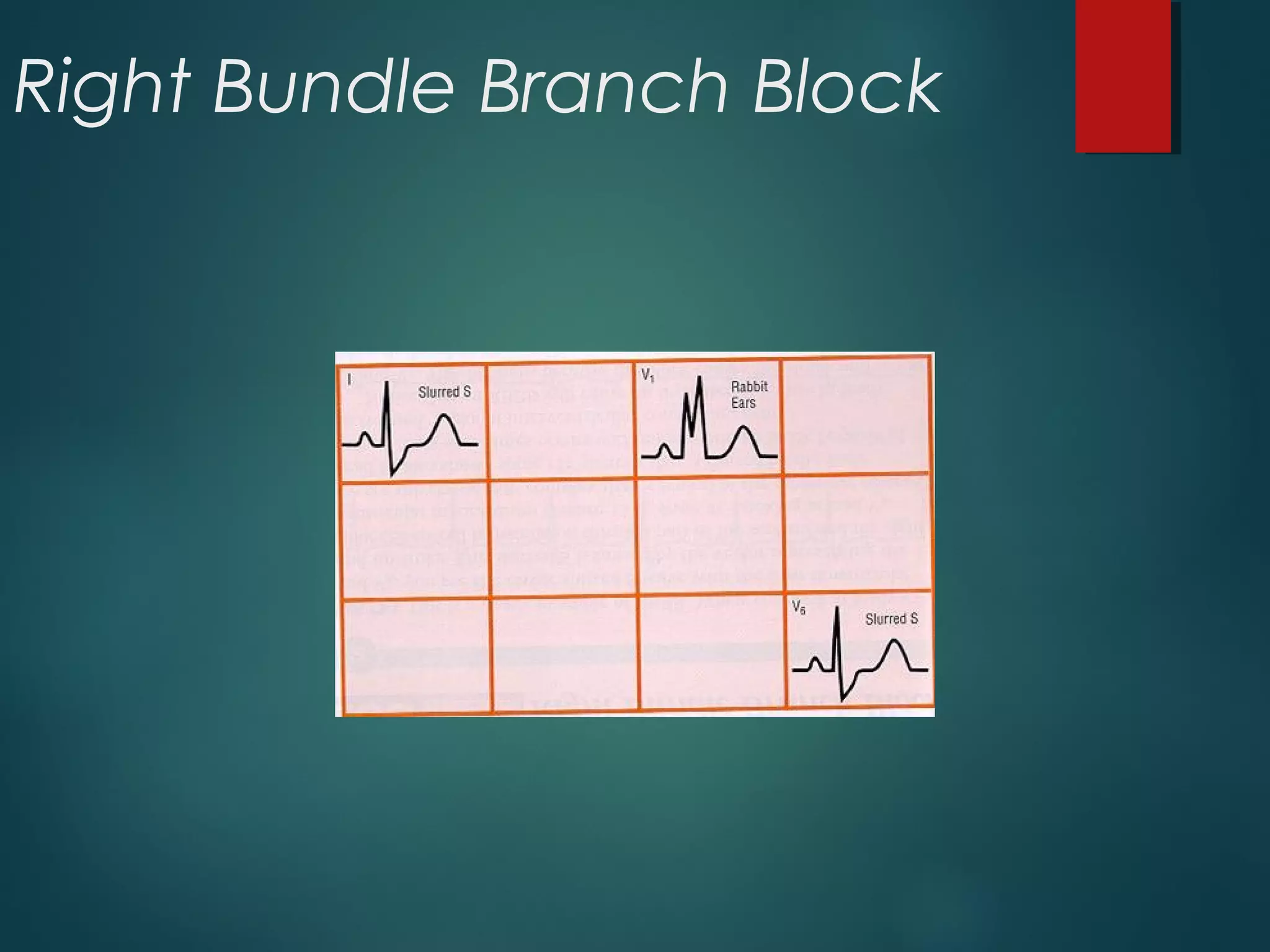 Right Bundle Branch Block
 