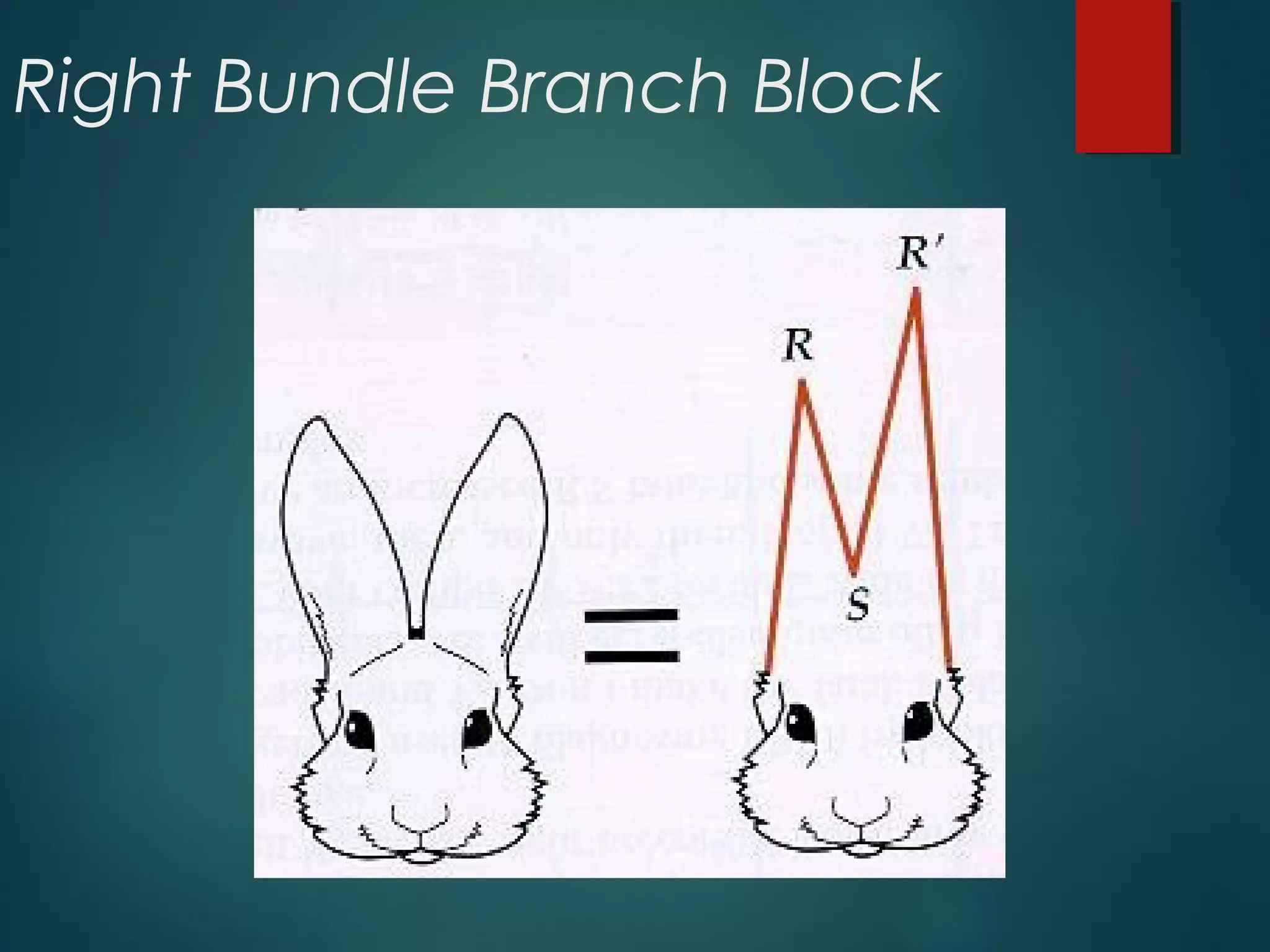 Right Bundle Branch Block
 