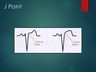 Basics of ecg interpretation by dr sai | PPT