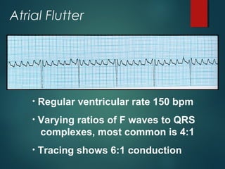 Basics of ecg interpretation by dr sai | PPT