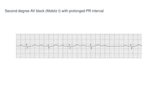 Comprehensive Basics of ECG: Understanding Heart's Electrical Activity ...