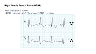 Rsr Rbbbb Comprehensive Basics of ECG: Understanding Heart's Electrical Activity ...