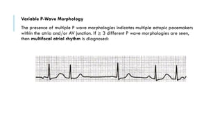 P Wave Pacemaker BASICS OF ELECTROCARDIOGRAPHY: A COMPREHENSIVE GUIDE | PDF