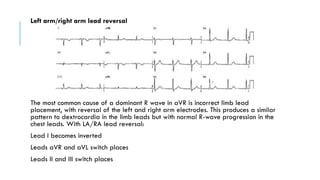 Avr Terminal R Wave BASICS OF ELECTROCARDIOGRAPHY: A COMPREHENSIVE GUIDE | PDF